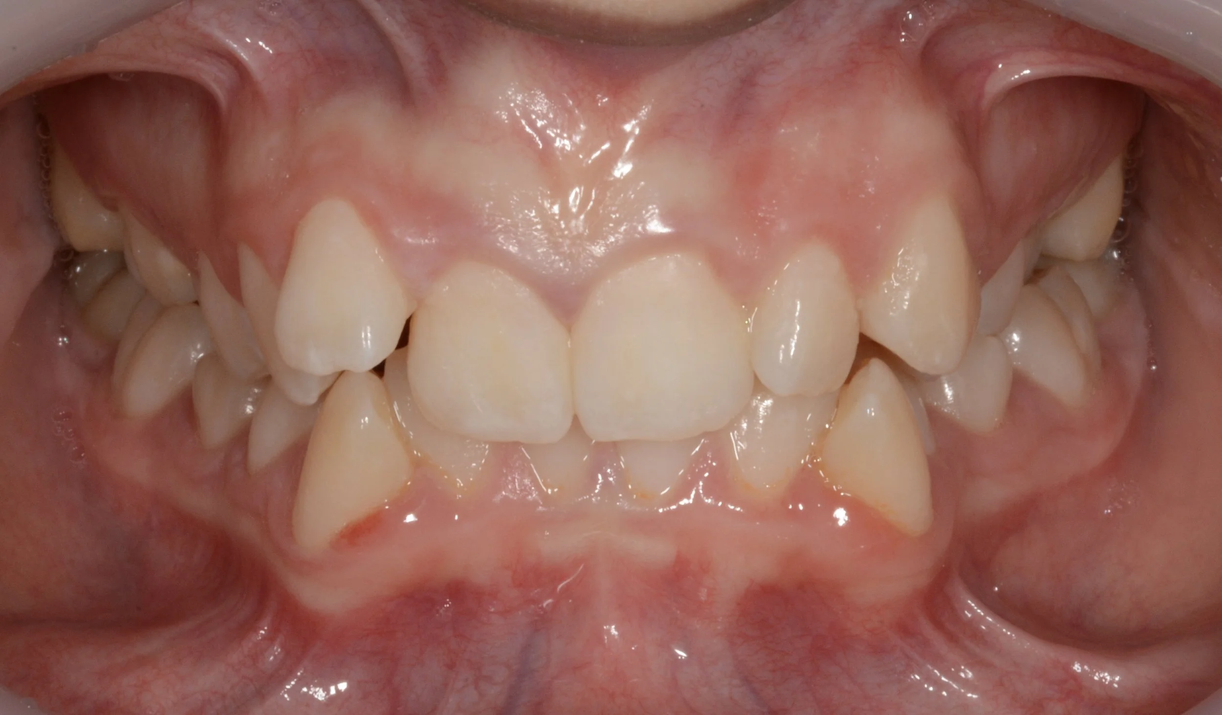 Close-up of a person's upper teeth and pink gums, showing misalignment and dental irregularities.