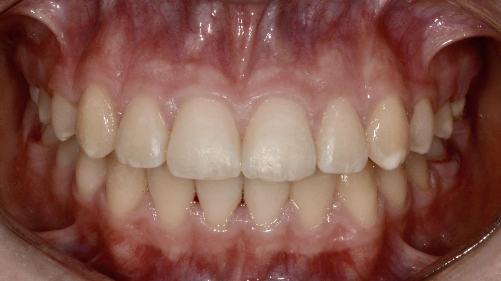 Close-up of a person's open mouth showing upper and lower teeth with healthy gums.