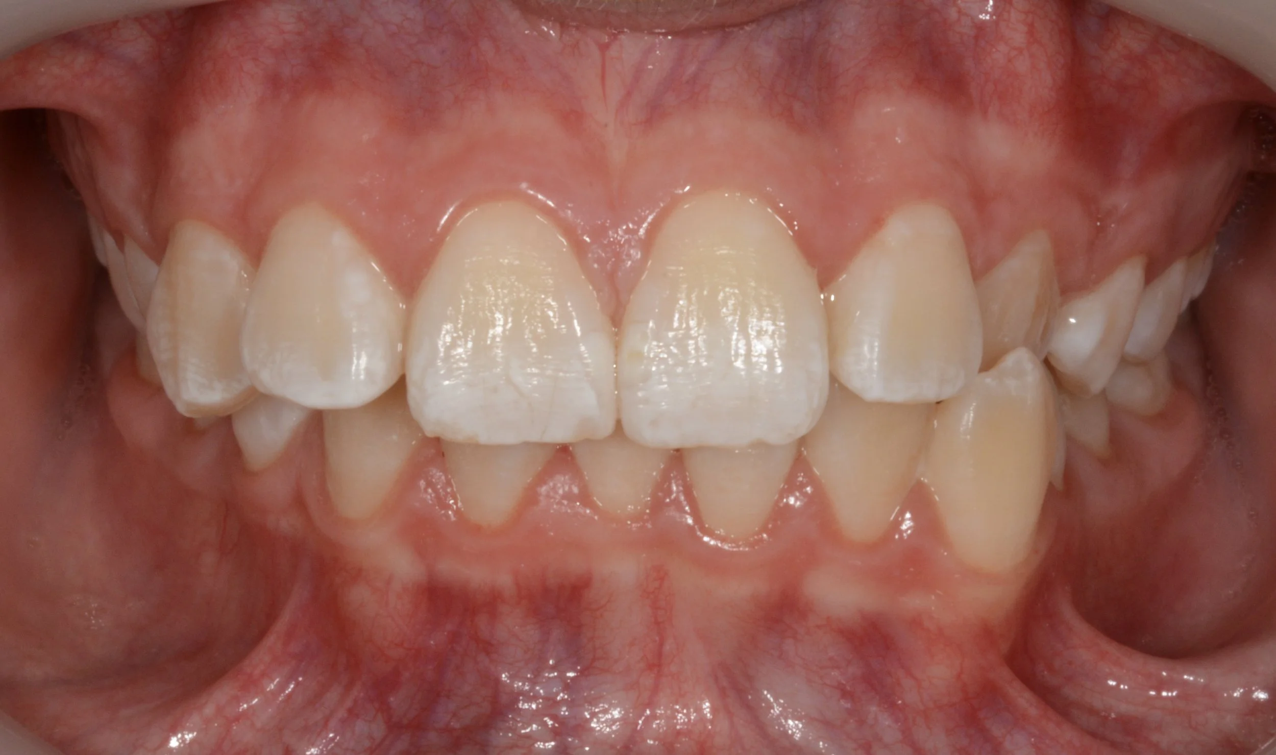 Close-up of a person's open mouth showing upper and lower teeth, with pink gums and visible tongue.