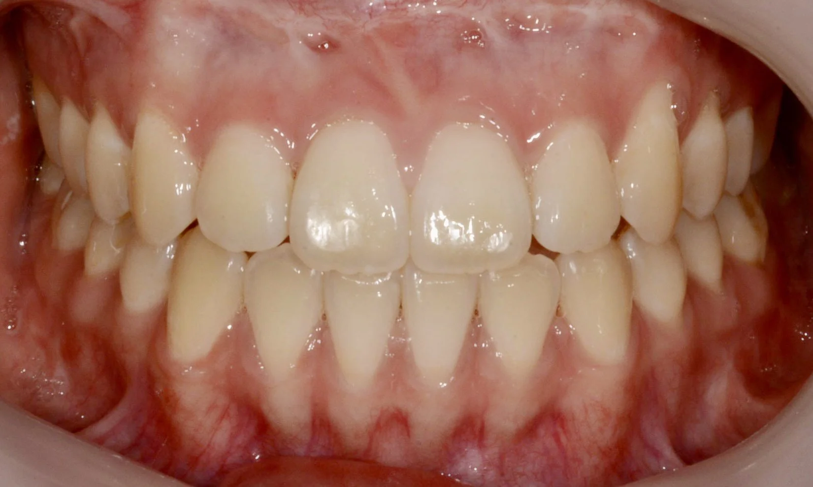 Close-up of a person's upper and lower teeth with healthy gums.