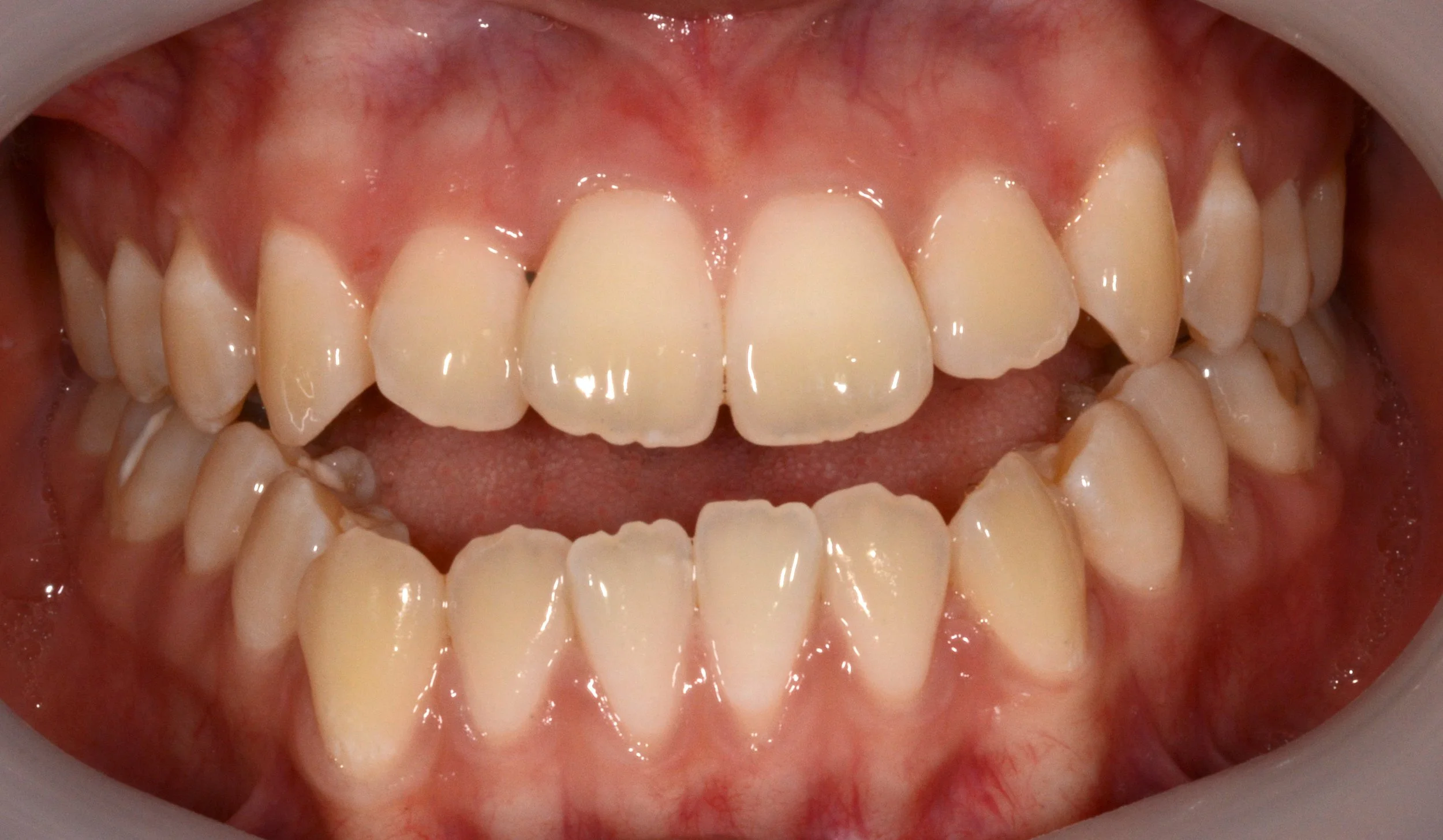Close-up of open mouth showing upper and lower teeth, with gum redness.