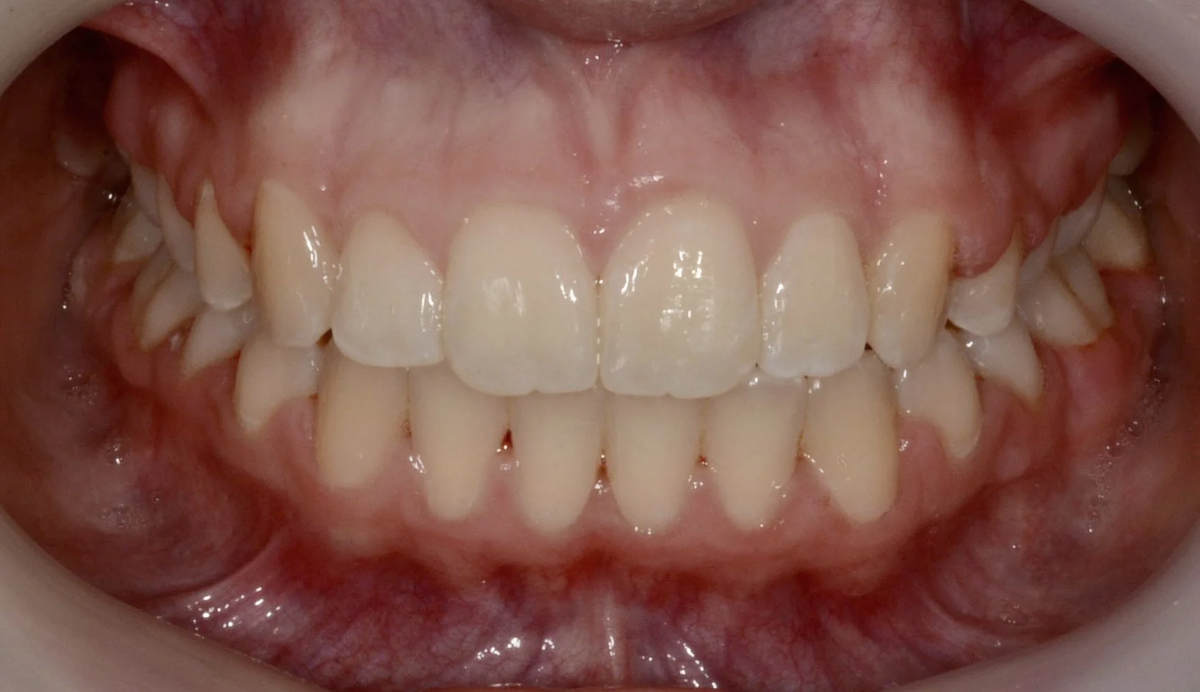 Close-up of a person's open mouth showing upper and lower teeth, gums, and tongue.