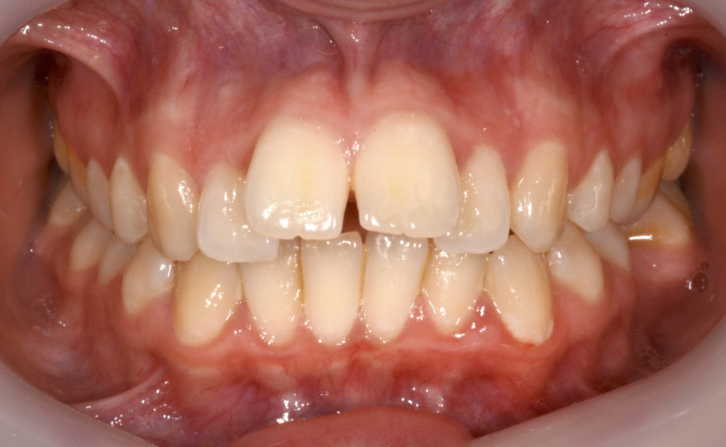 Close-up of a person's open mouth showing upper and lower teeth with some misalignment; the gums and tongue are visible.