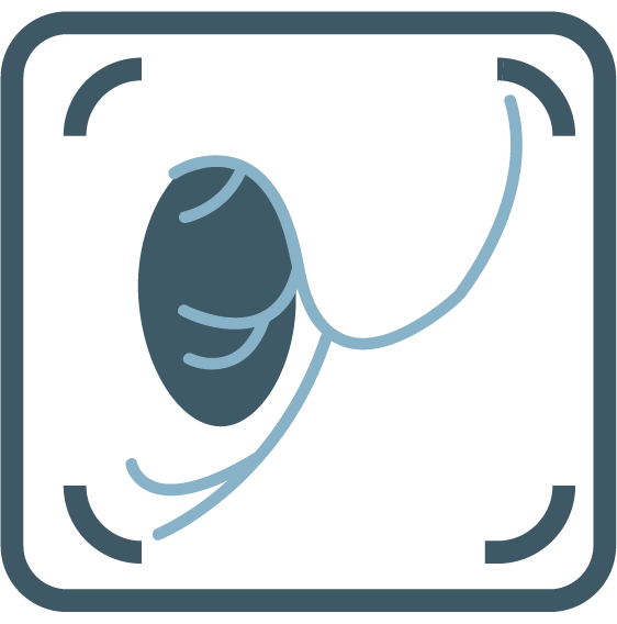 Uterine Fibroid/Artery Embolisation (UFE/UAE)