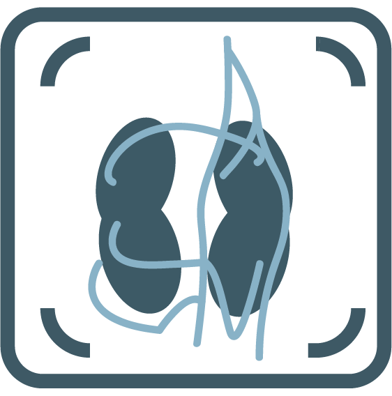 Genicular Artery Embolisation