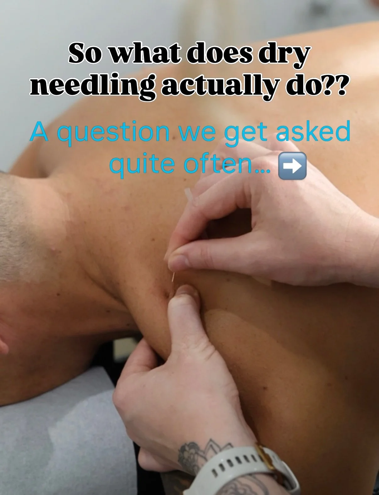 Have you tried dry needling, or ever wondered what it actually does? 🤔

Our practitioners commonly integrate dry needling into treatment because of the research and clinical backing behind it.

&bull; Targets soft tissue tightness &amp; injury to re