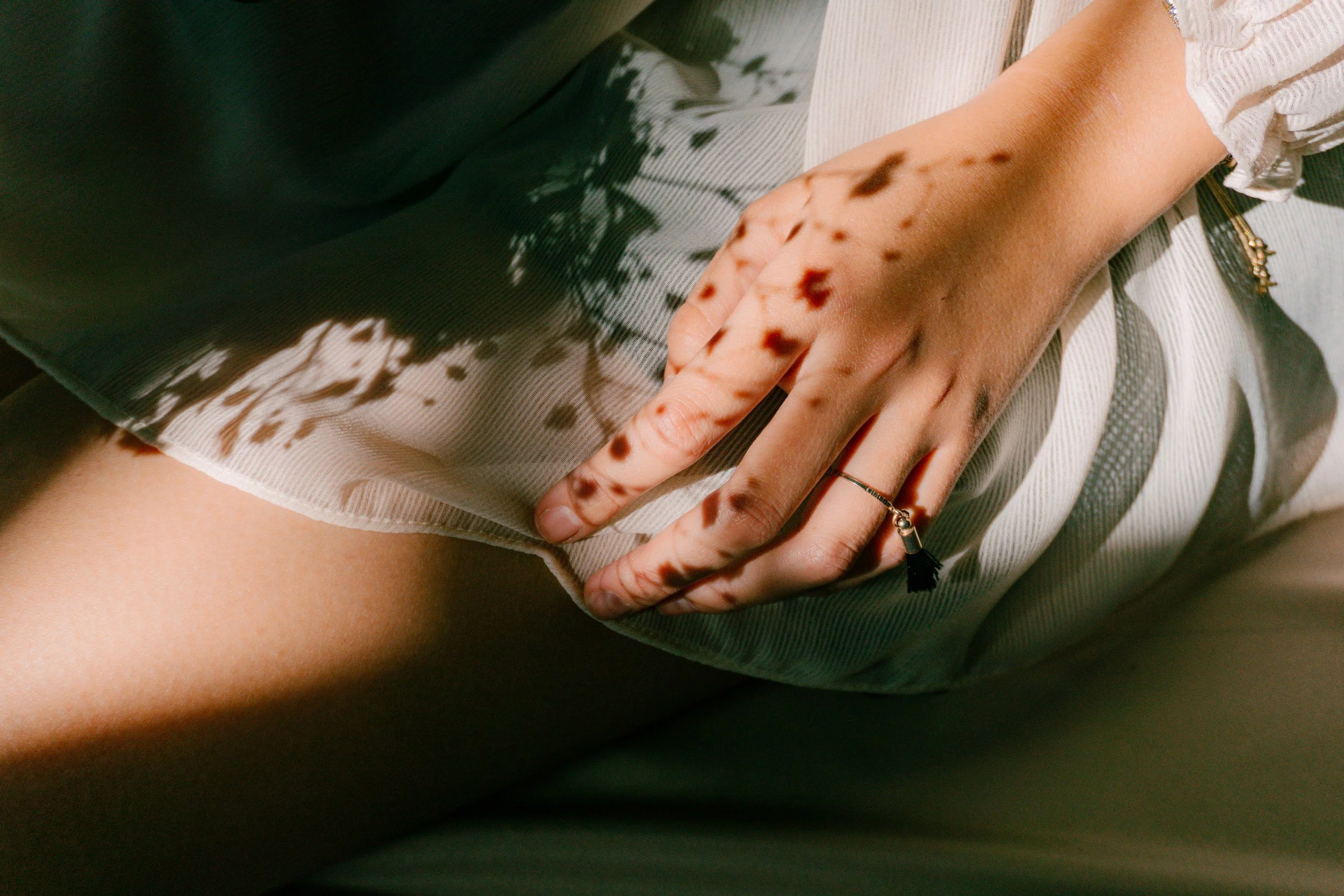 Person's hand resting on their thigh, with visible skin marks that resemble bruises or skin discolorations.