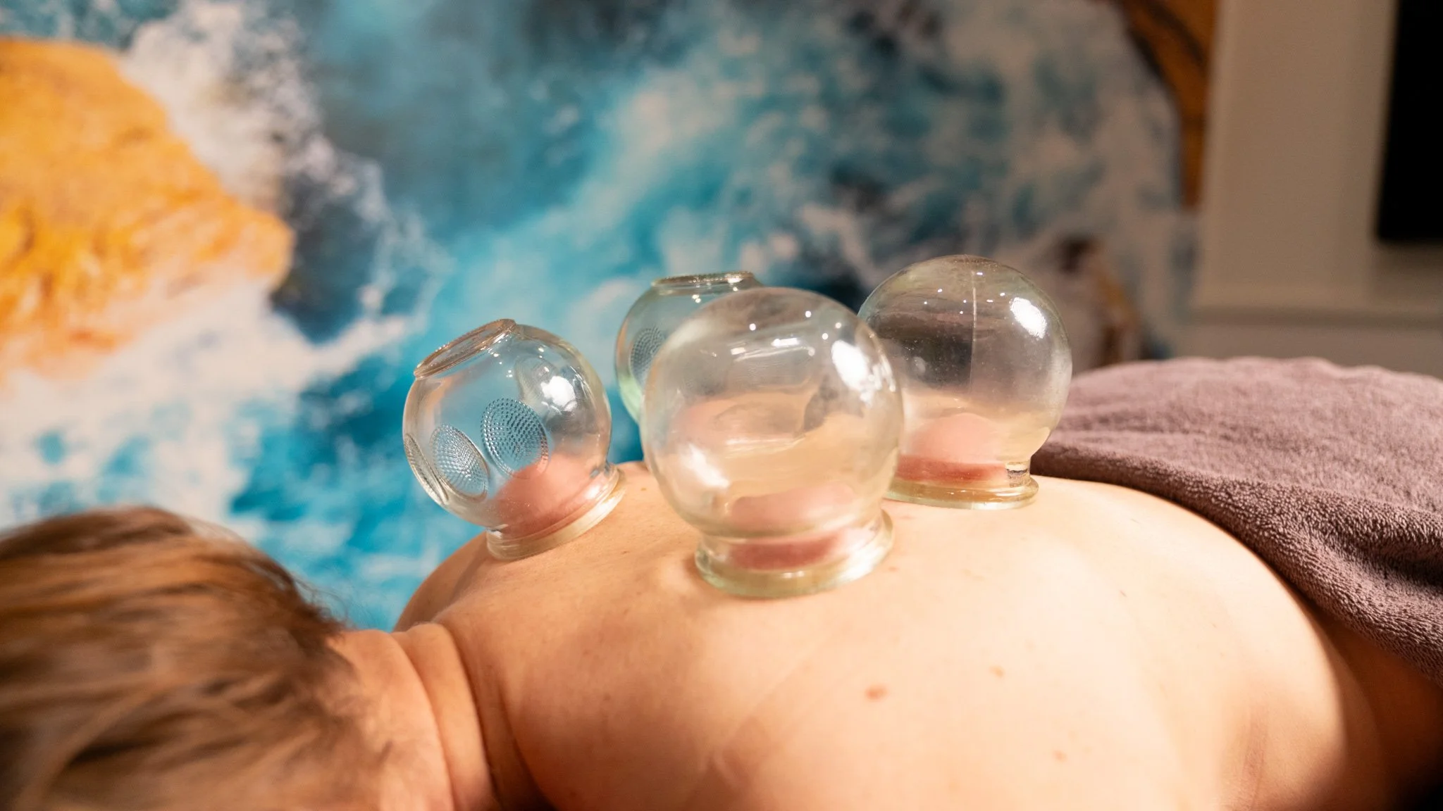 acupuncture for neck pain wollongong- A person lying face down on a treatment table receiving hot stone therapy with three smooth, transparent stones placed along their back
