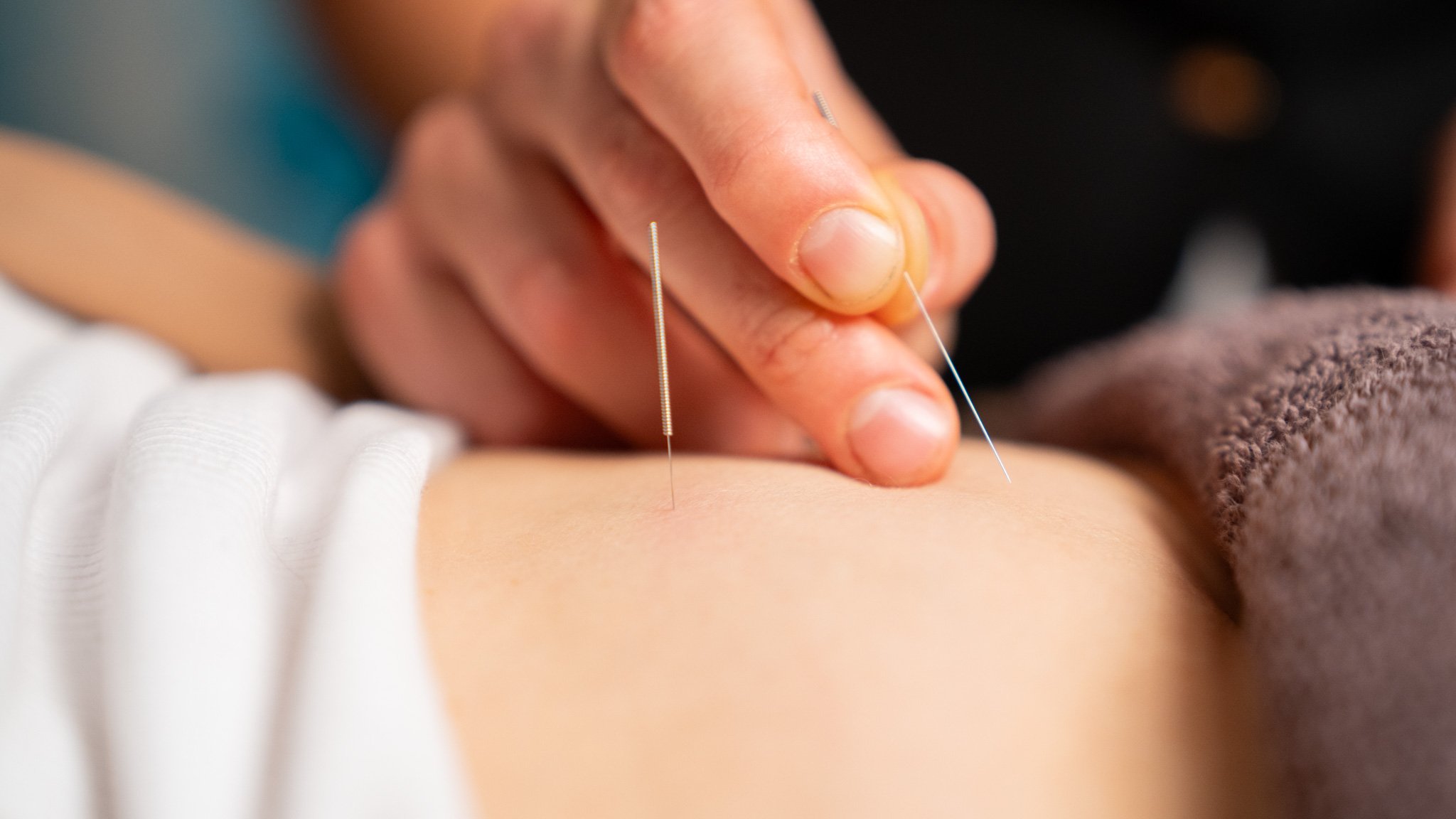 acupuncture clinic wollongong - Close-up of an acupuncture session showing a practitioner's hand inserting a fine needle into a person's skin.