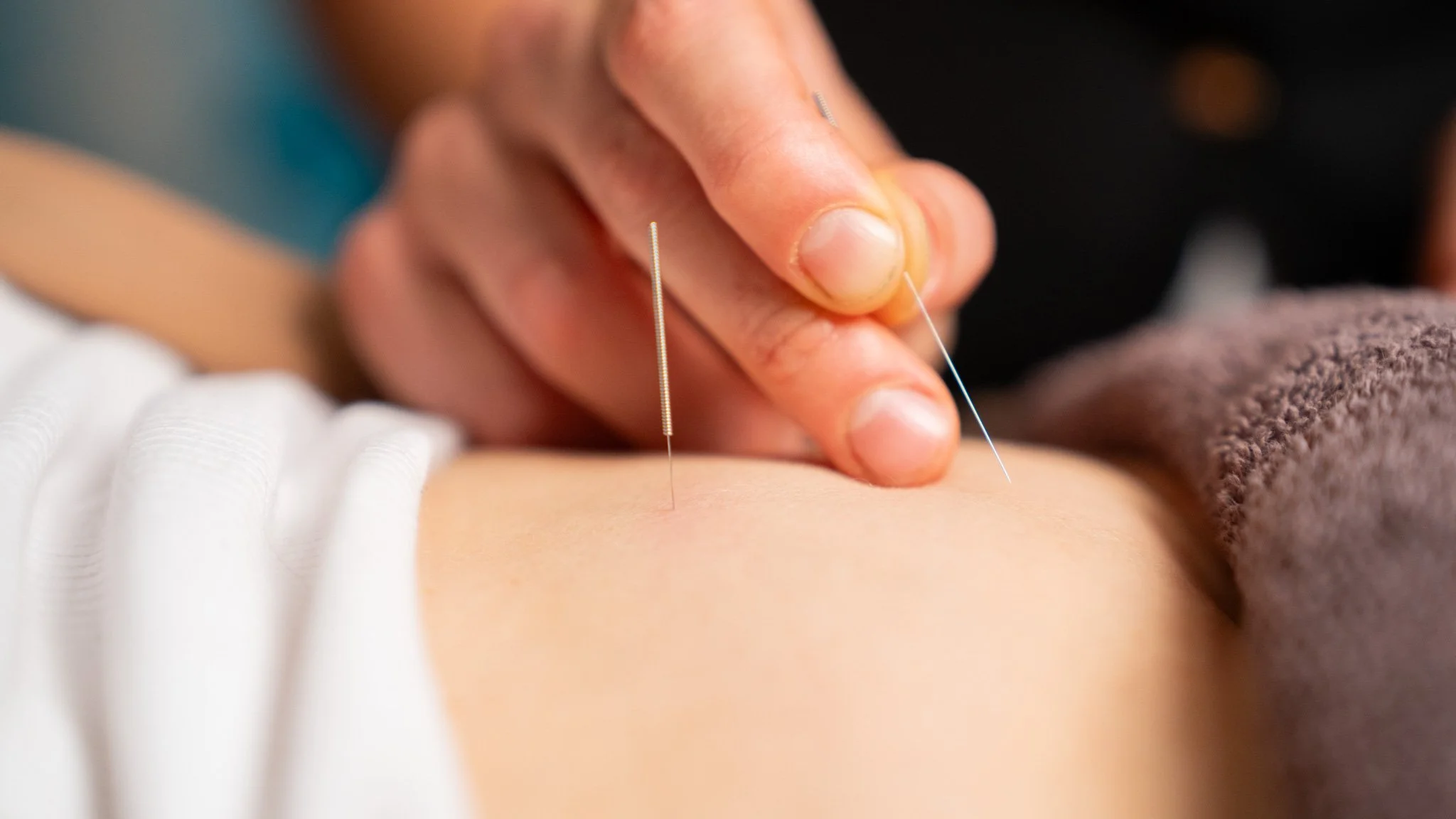 Close-up of an acupuncturist inserting thin needles into a person's back.