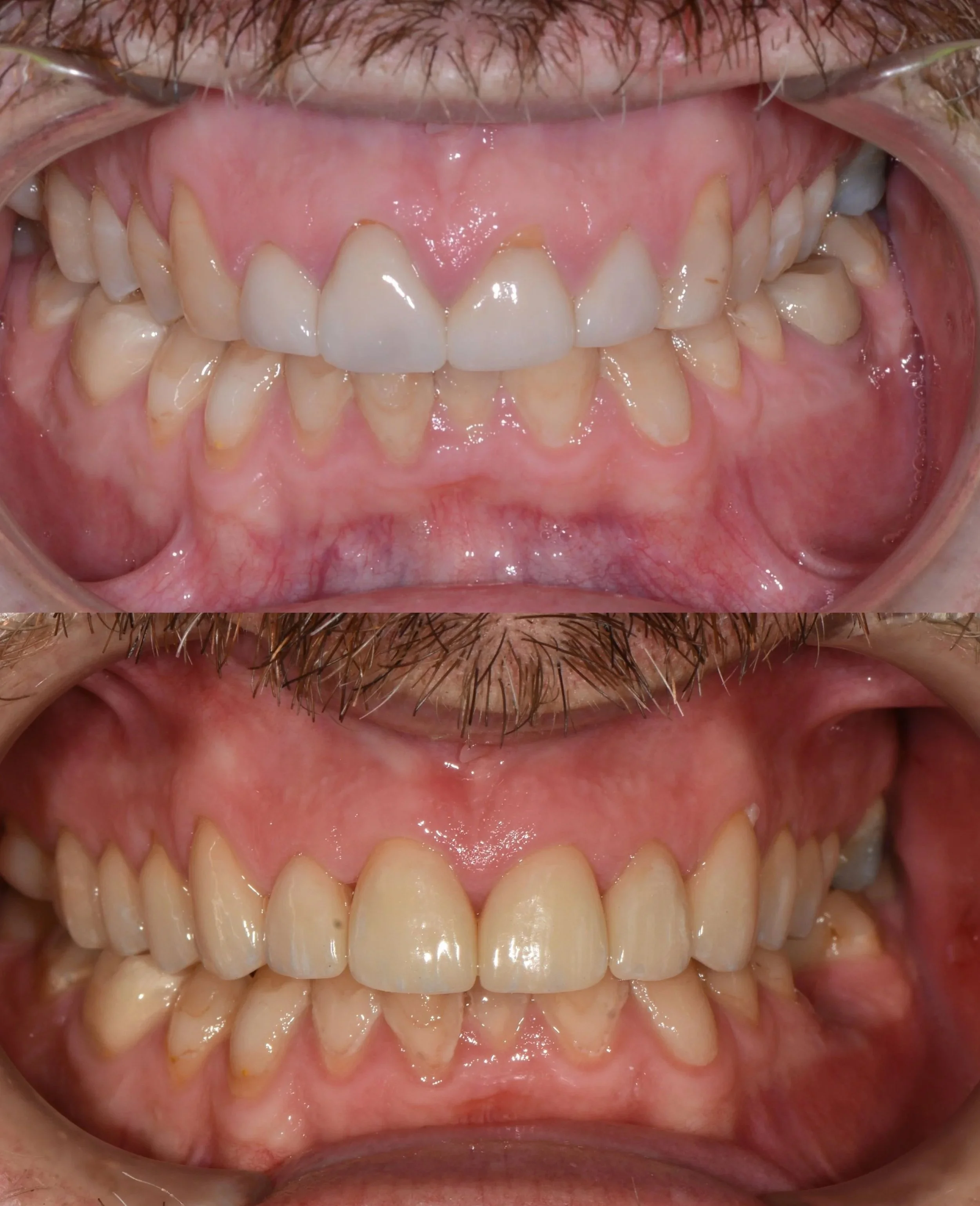 Ceramic crowns and veneers. Top: Before. Bottom: After.