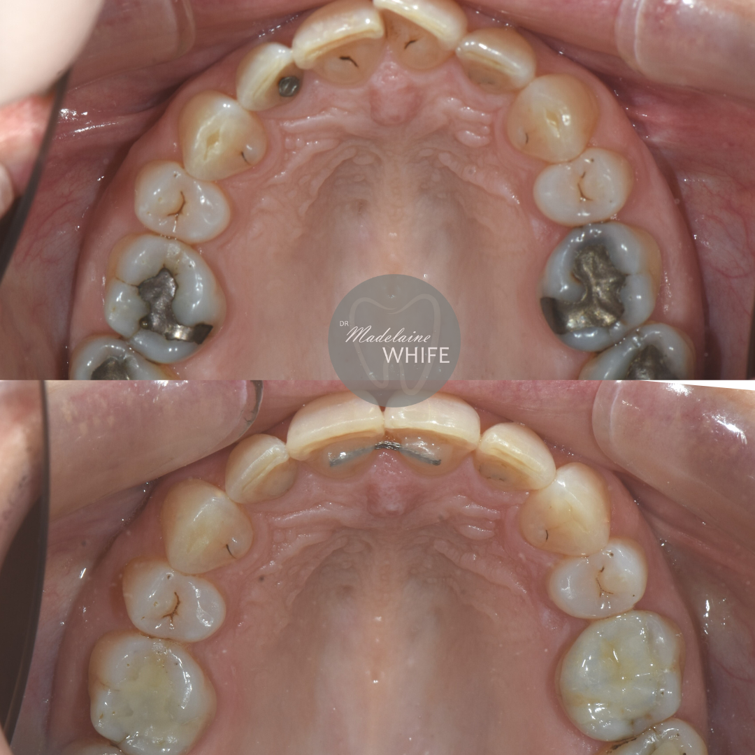 Top: Before.    Bottom: After.