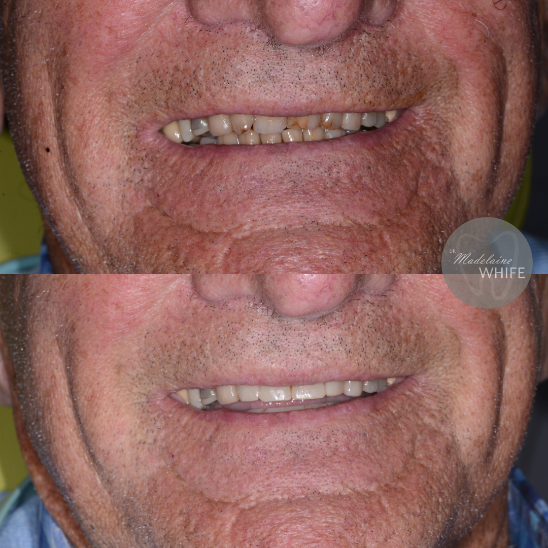 Composite bonding. Top: Before. Bottom: After.