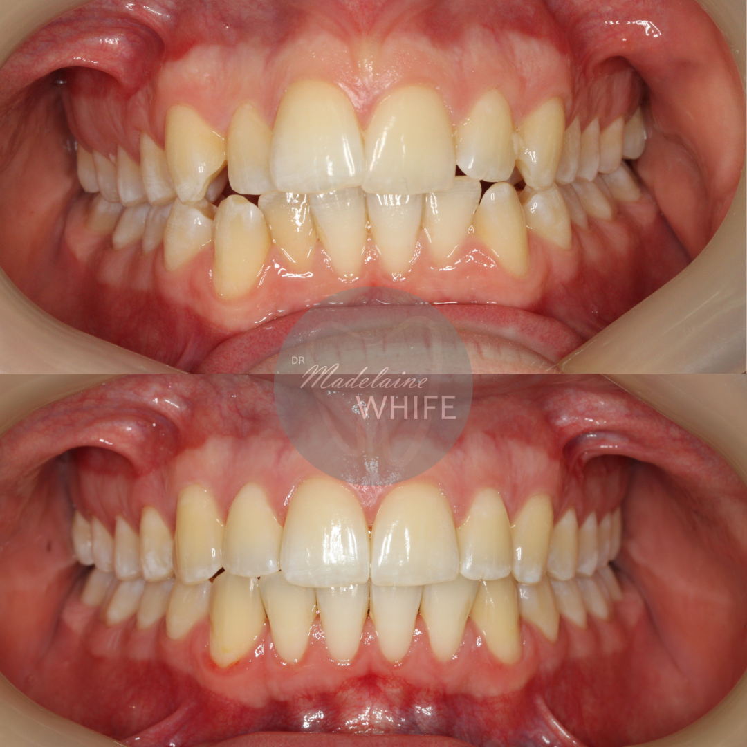 Top: Before.    Bottom: After.