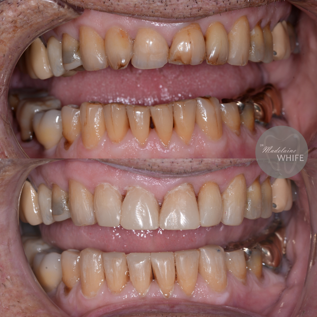 Composite bonding. Top: Before. Bottom: After.