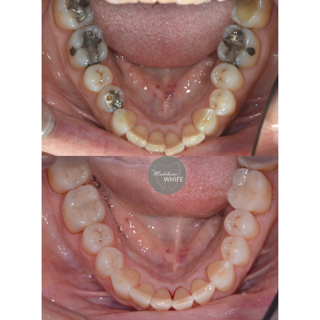 Top: Before.    Bottom: After.