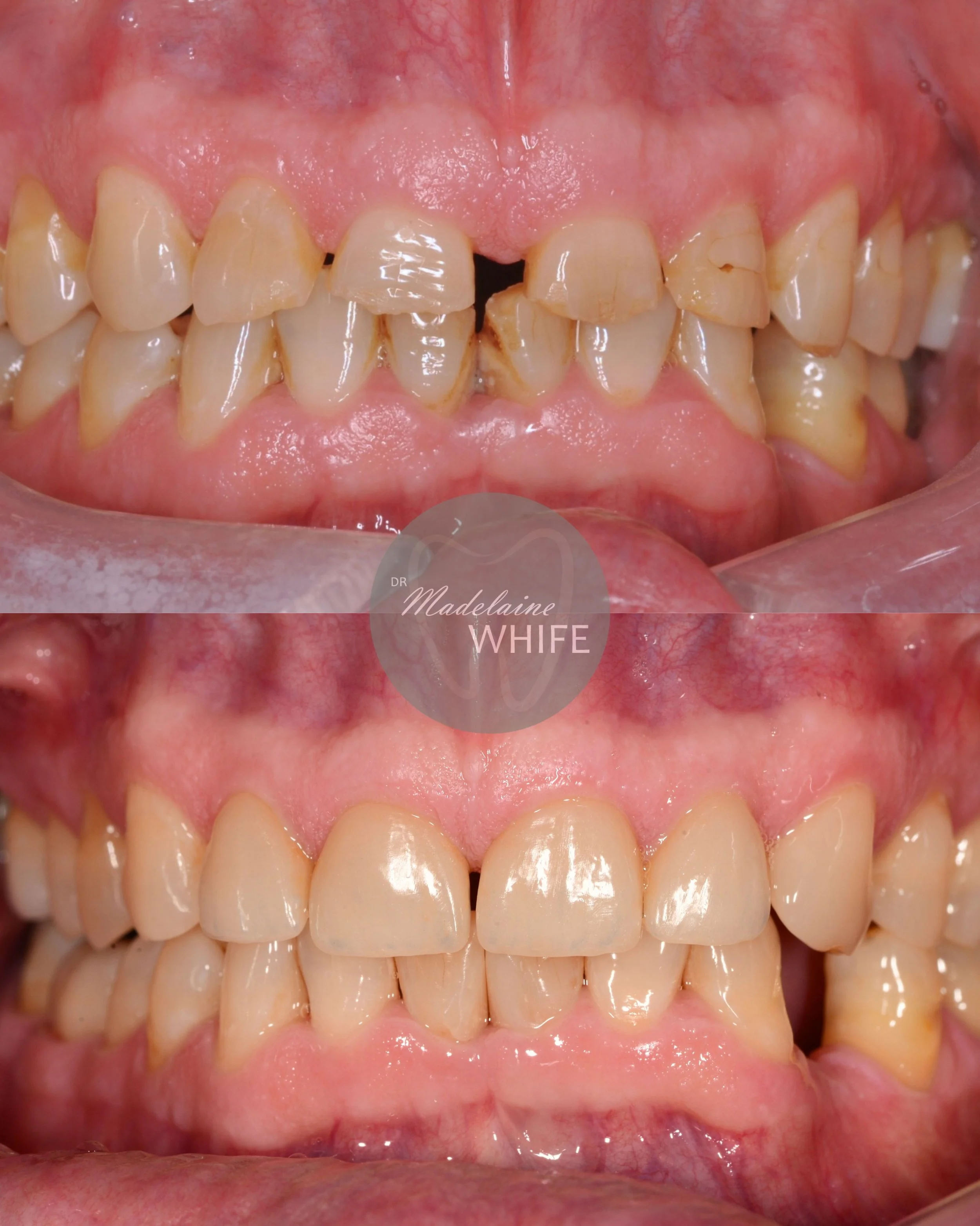 Four ceramics on upper incisors. Top: Before. Bottom: After.