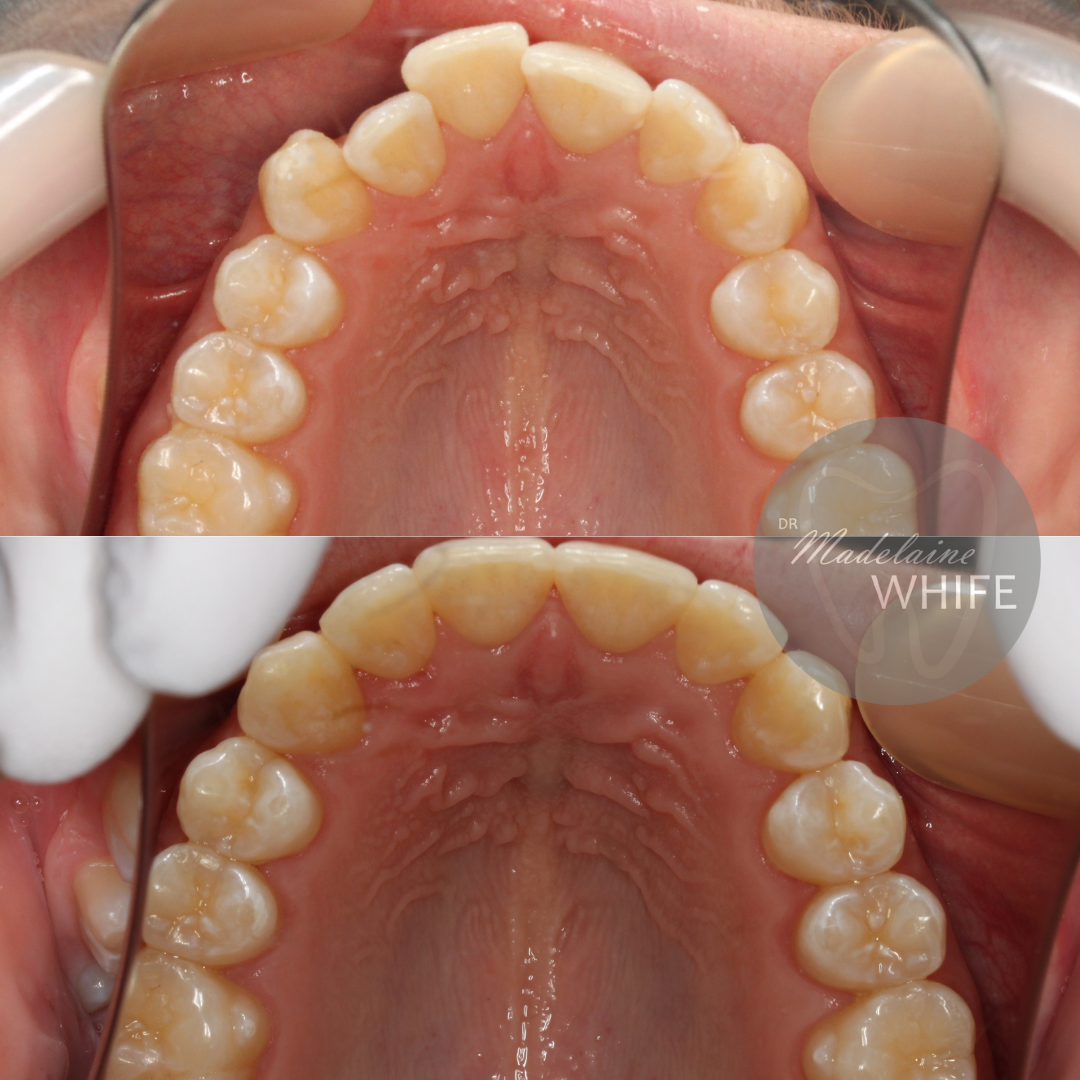 Top: Before.    Bottom: After.