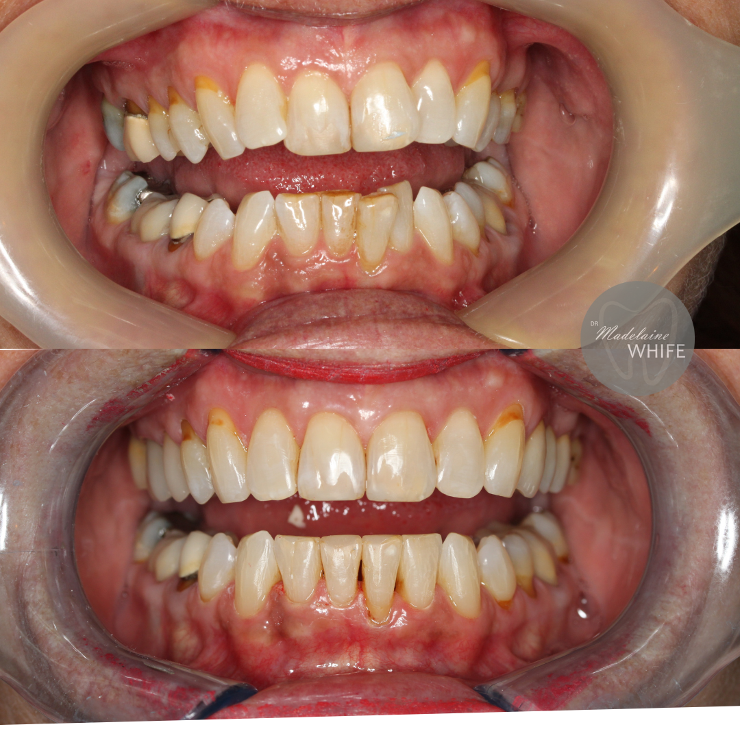 Top: Before.    Bottom: After.