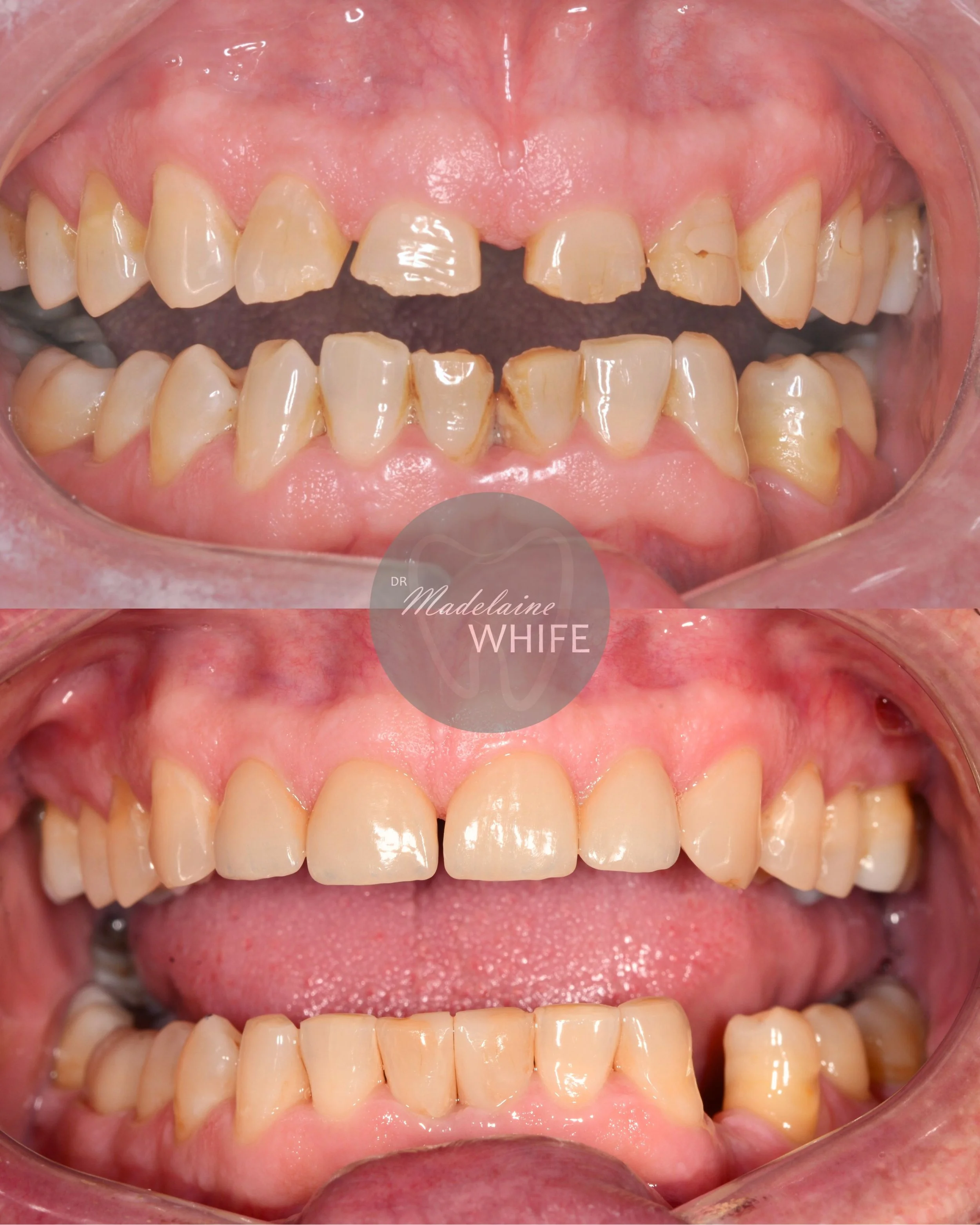 Four ceramics on upper incisors. Top: Before. Bottom: After.