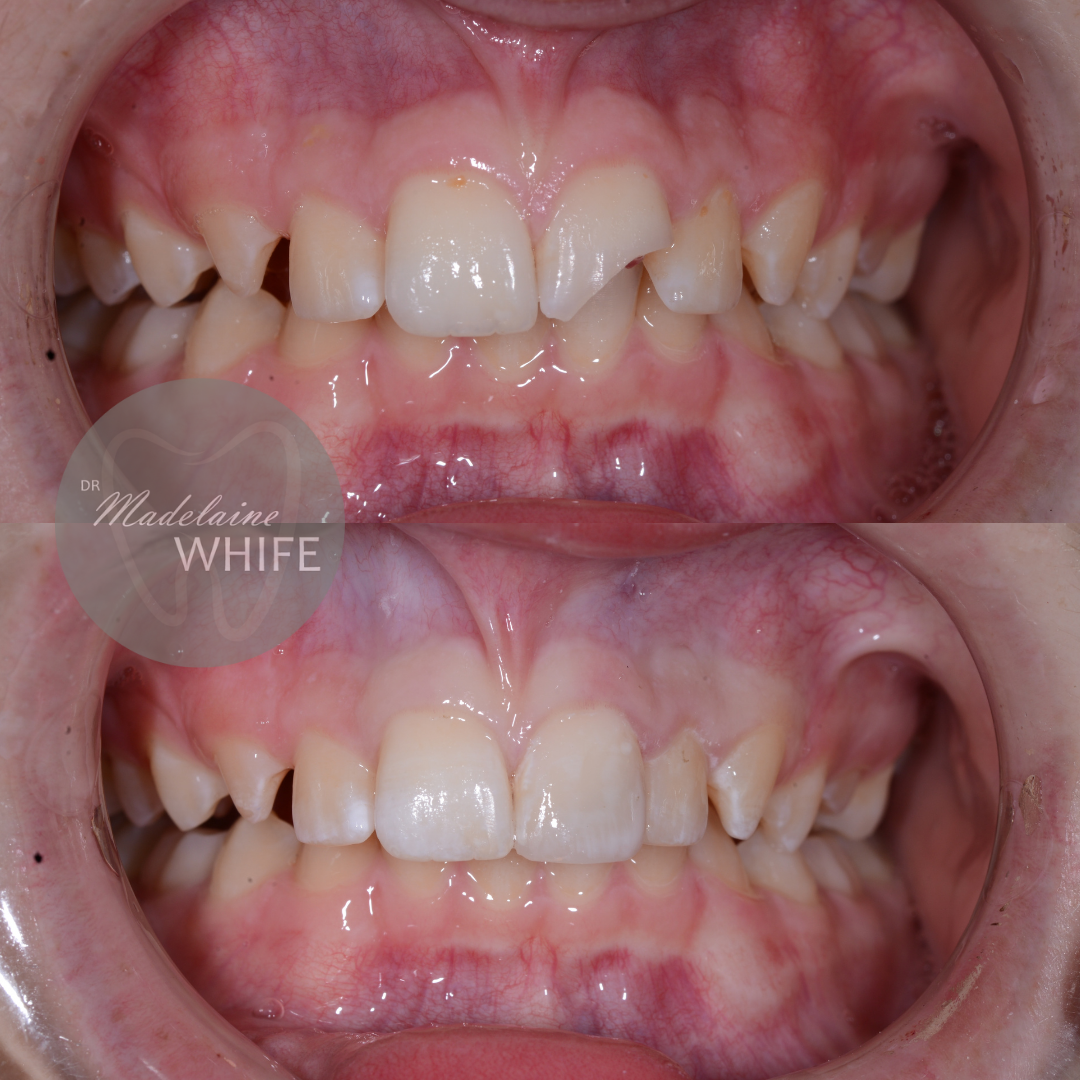 Composite bonding. Top: Before. Bottom: After.