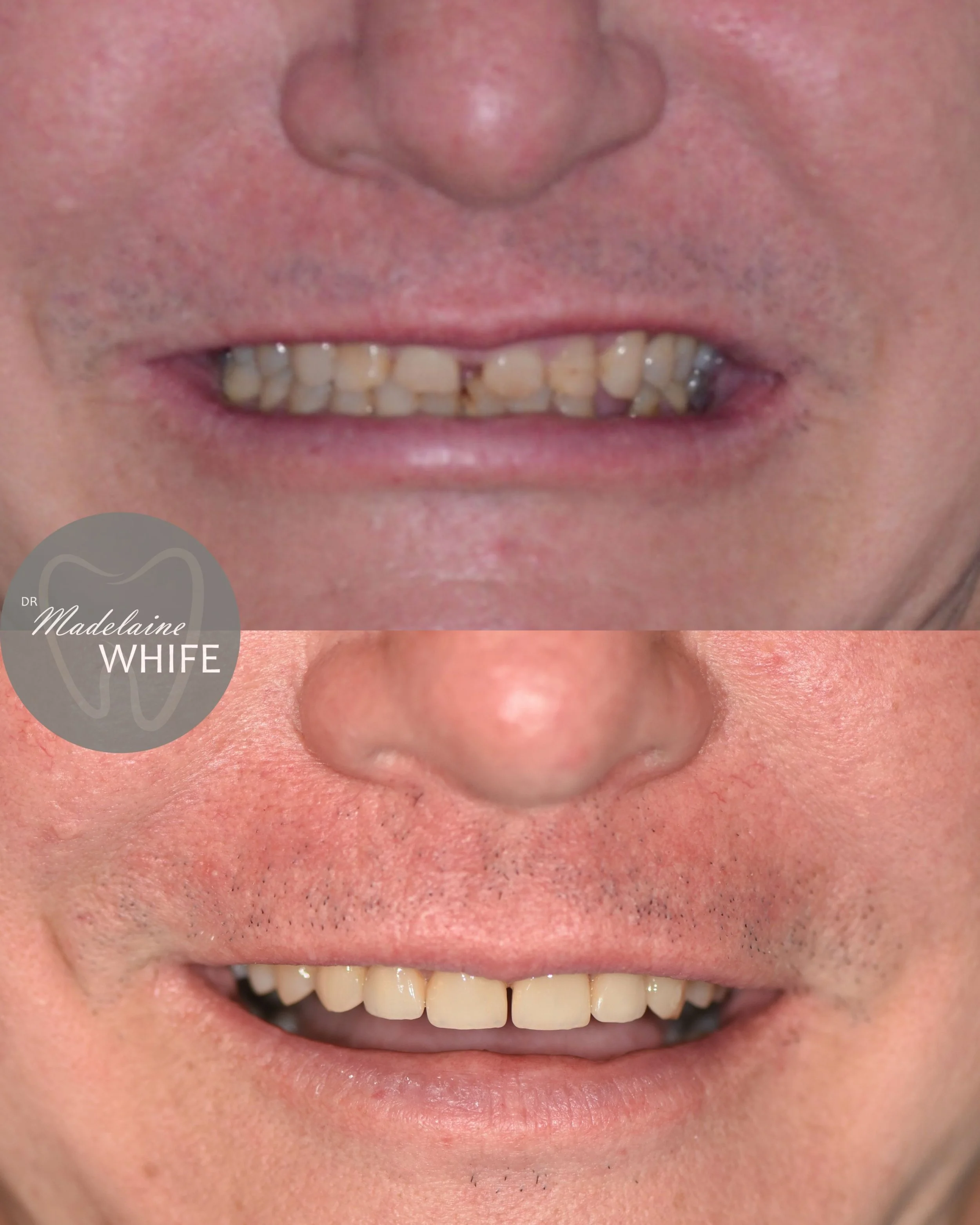 Four ceramics on upper incisors. Top: Before. Bottom: After.