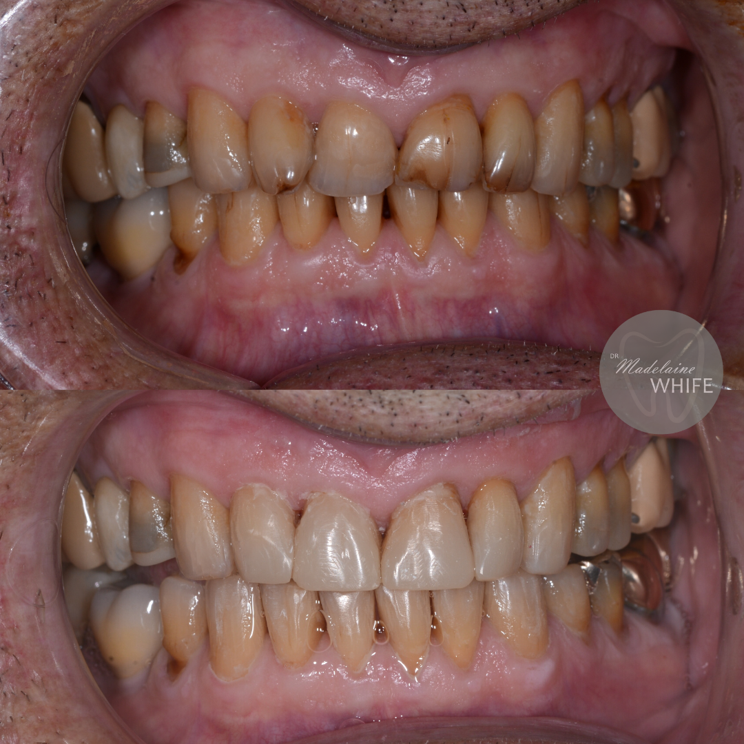 Composite bonding. Top: Before. Bottom: After.