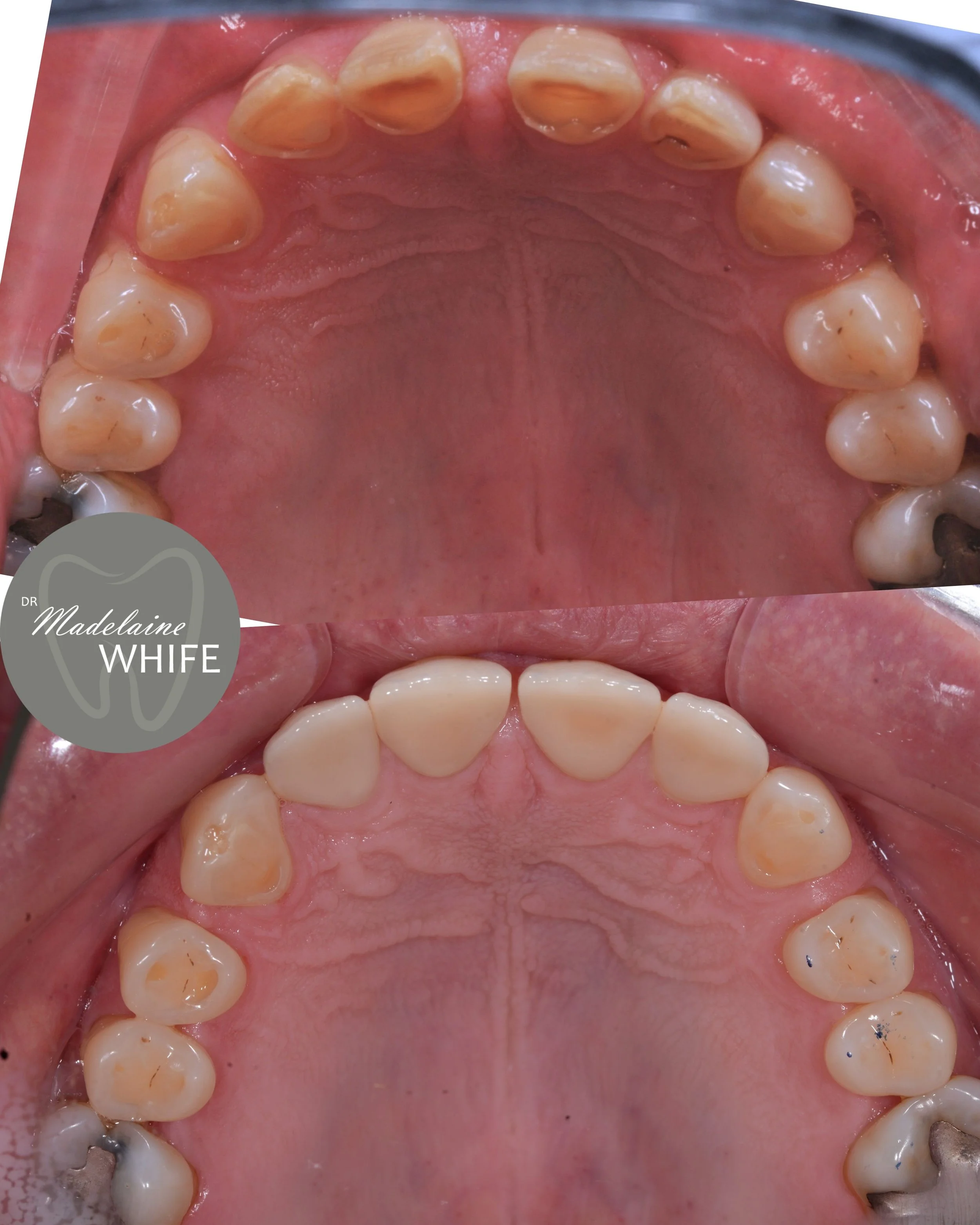 Four ceramics on upper incisors. Top: Before. Bottom: After.