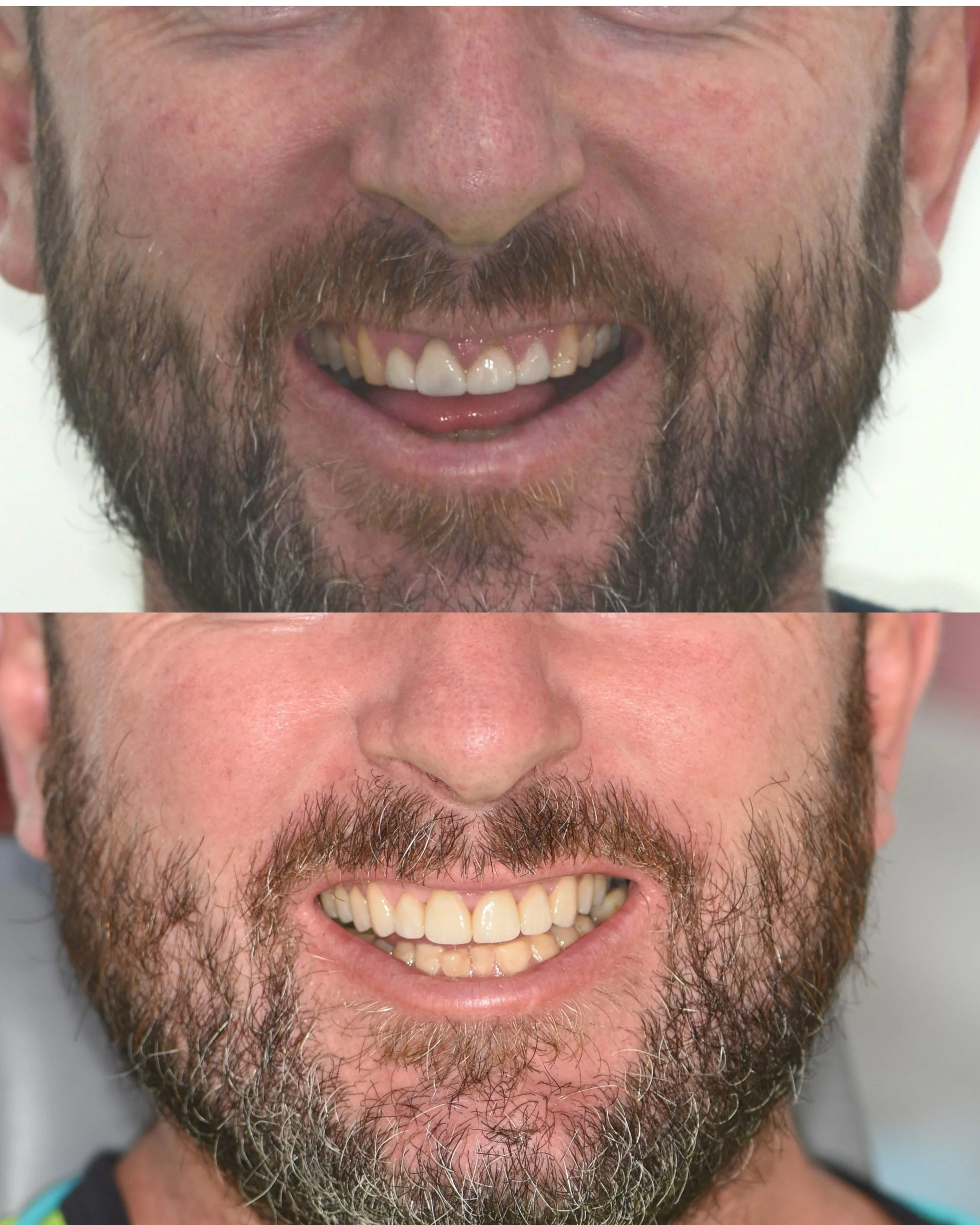 Ceramic crowns and veneers. Top: Before. Bottom: After.