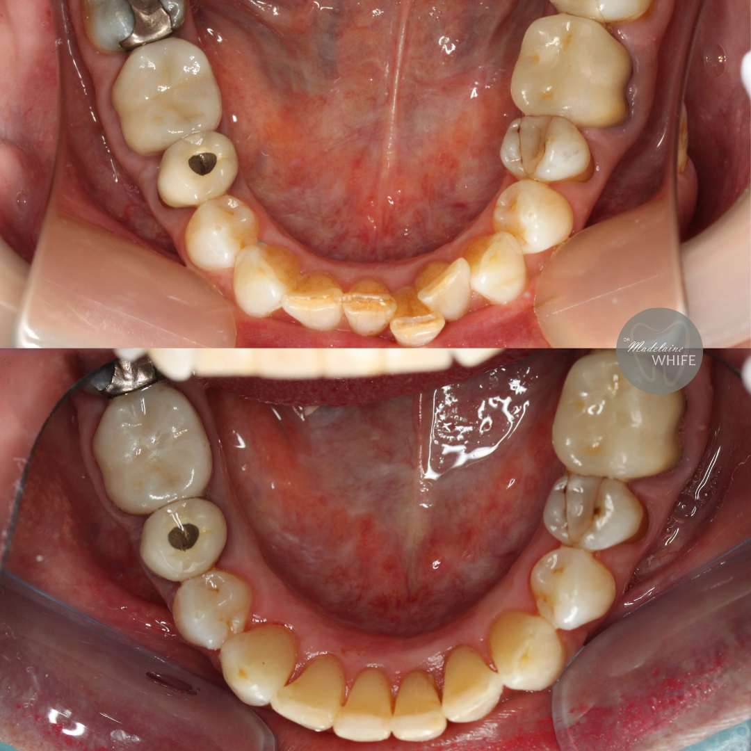 Top: Before.    Bottom: After.