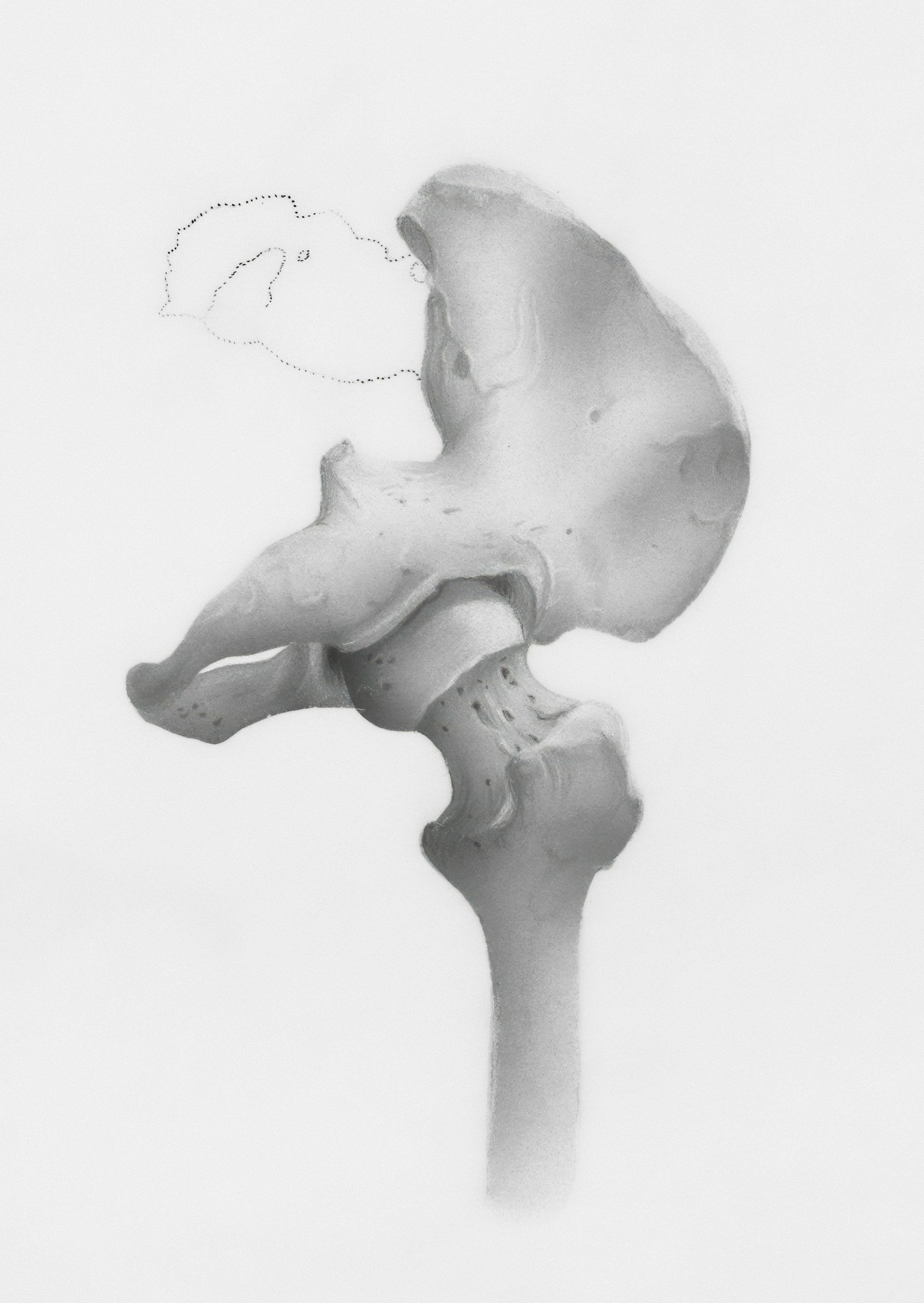 When is a Hip replacement the best course of action?
