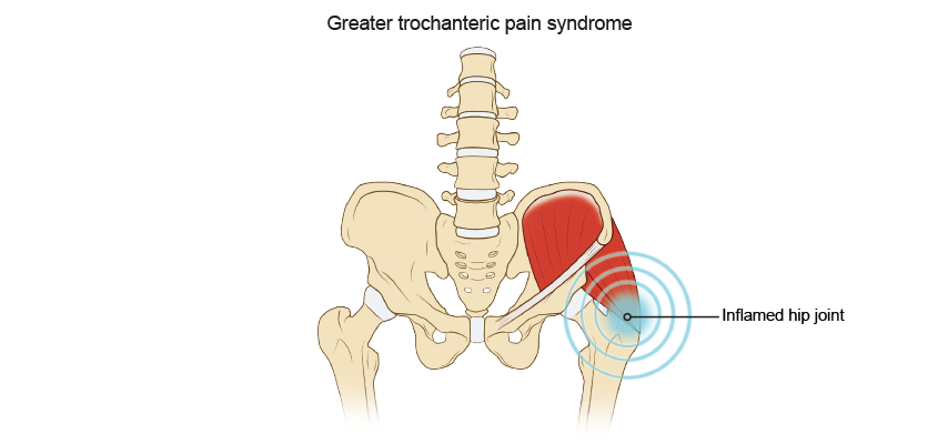 Greater Trochanteric Pain Syndrome (GTPS)