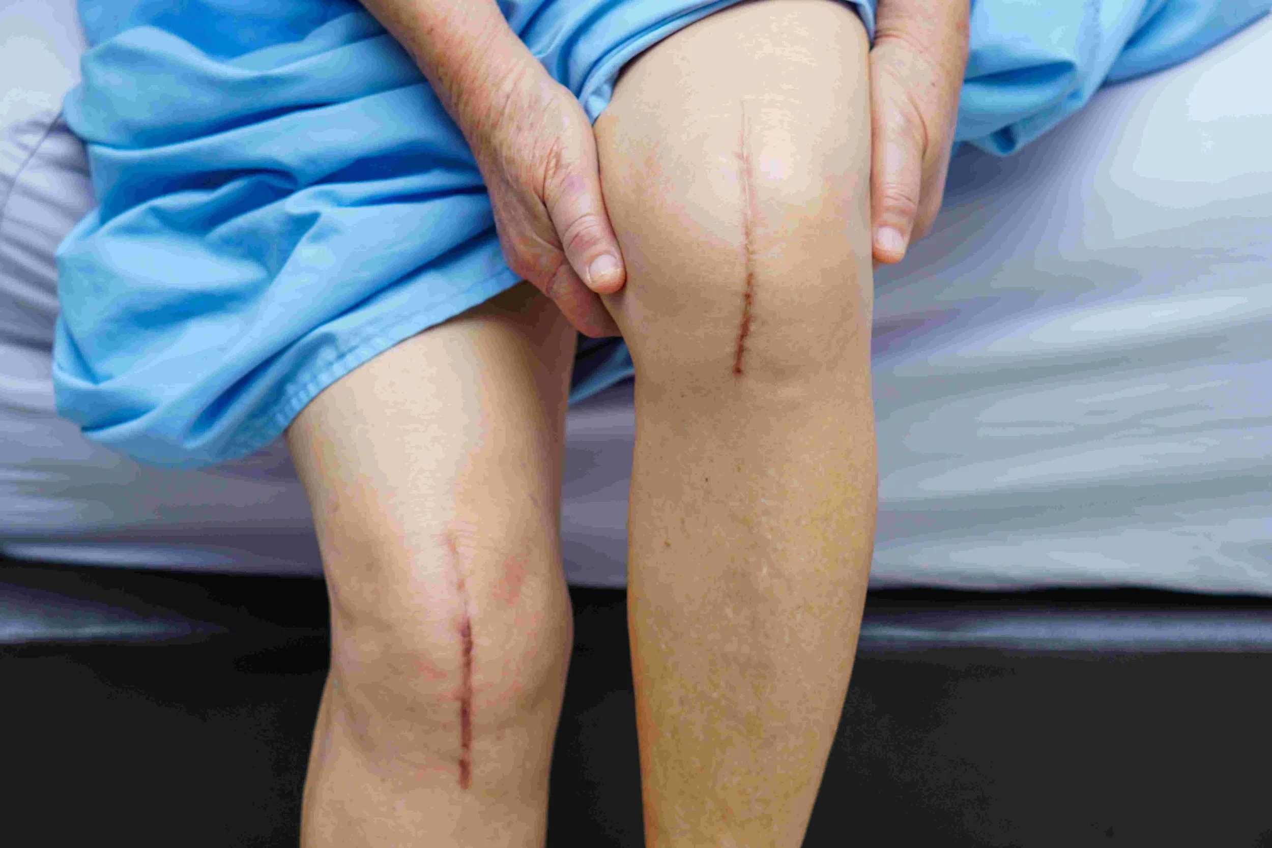Deep Scar tissue