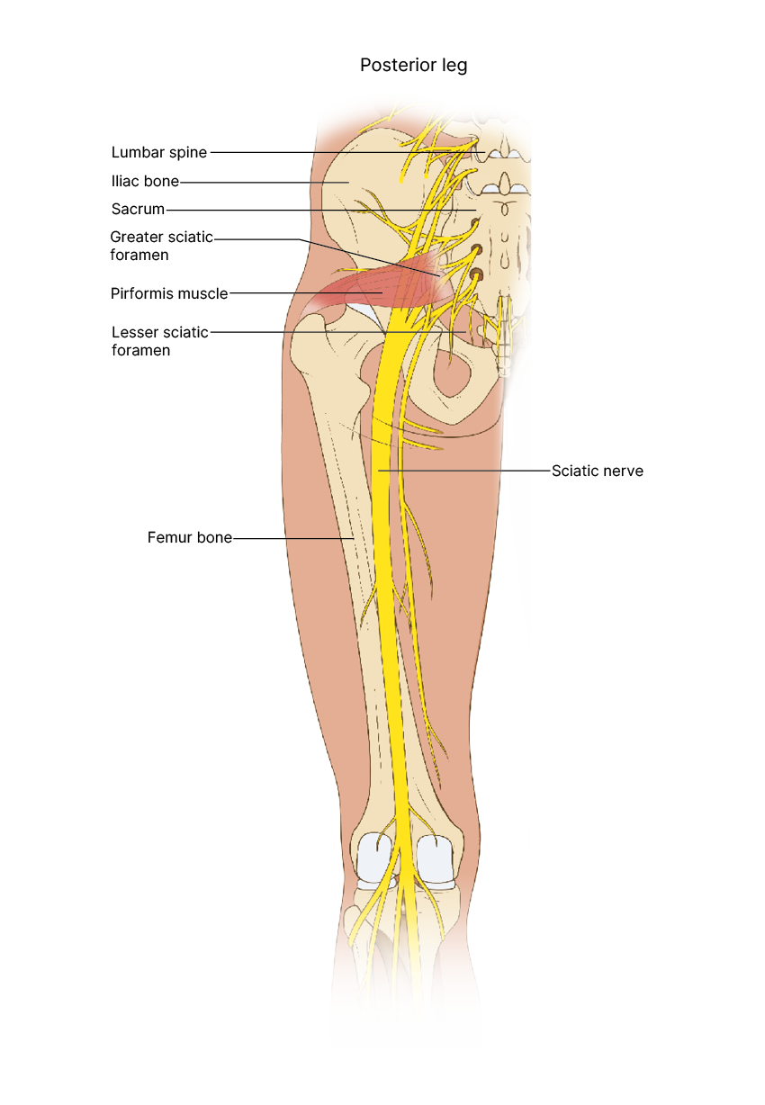 Sciatica