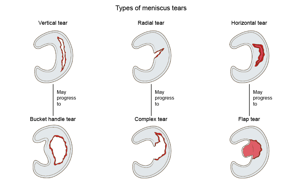 image of different types of meniscal tears