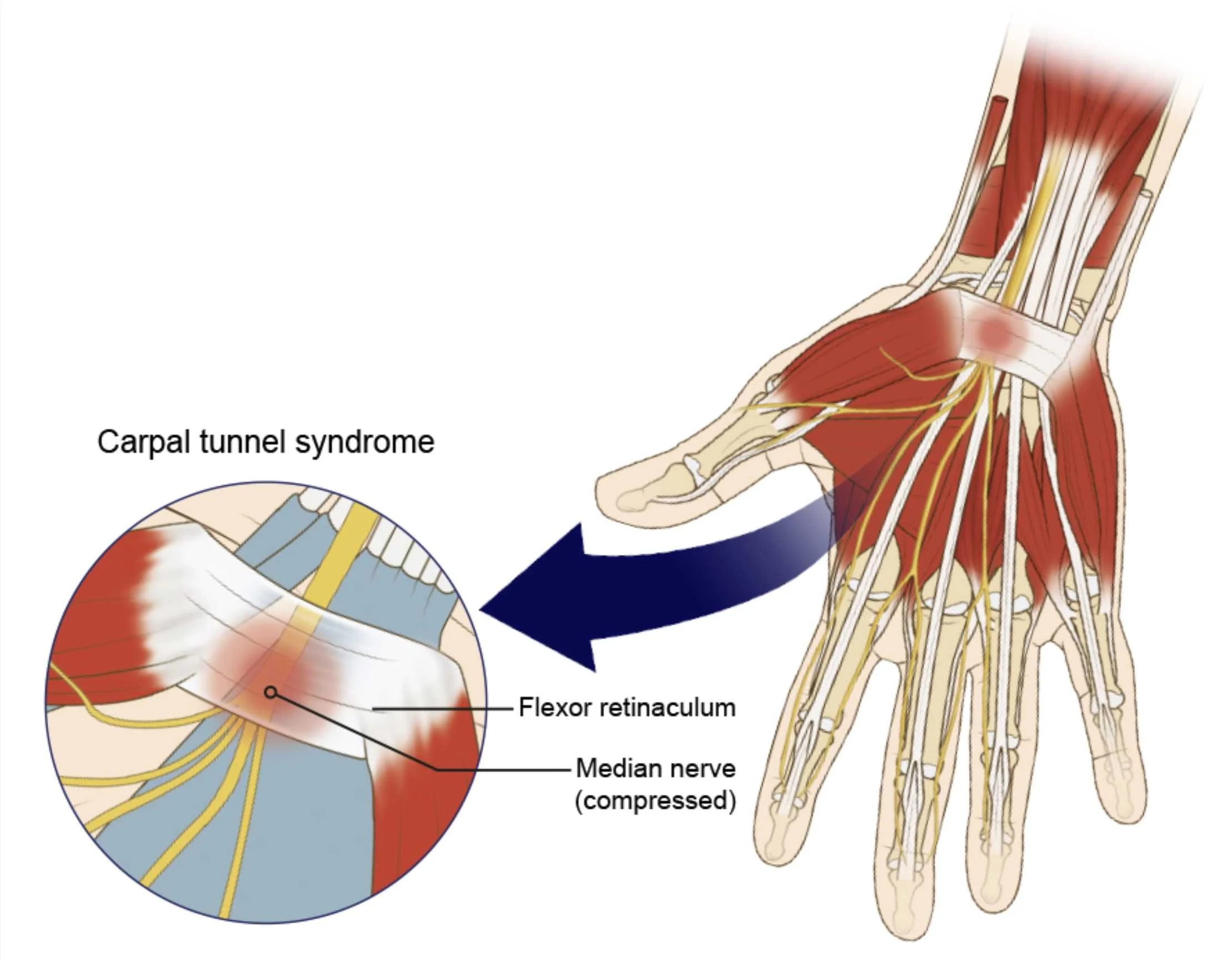 image of wrist anatomy and median nerve being compressed