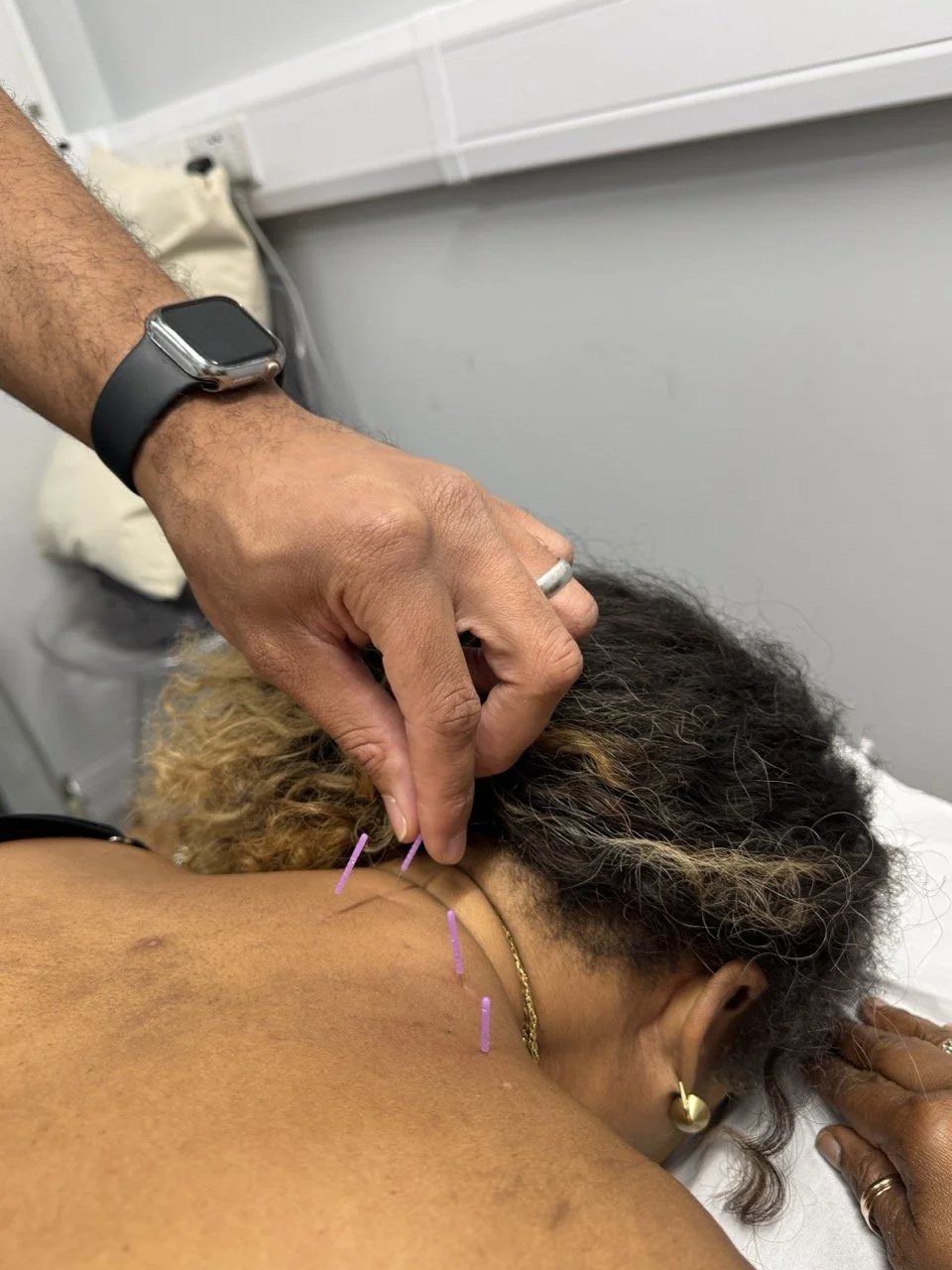 A person receiving acupuncture treatment on the neck and shoulder area, with purple acupuncture needles inserted, while lying on a treatment table.