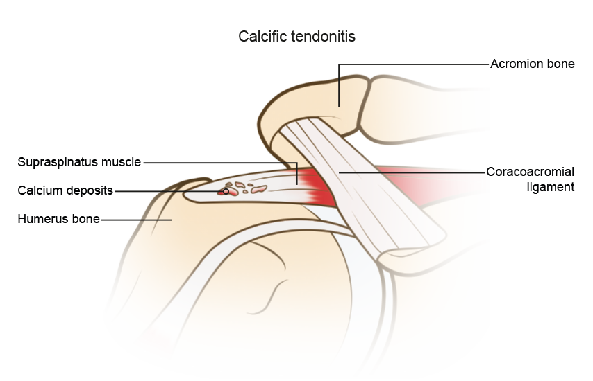 diagram of the shoulder illustrating calcium deposits within a tendon