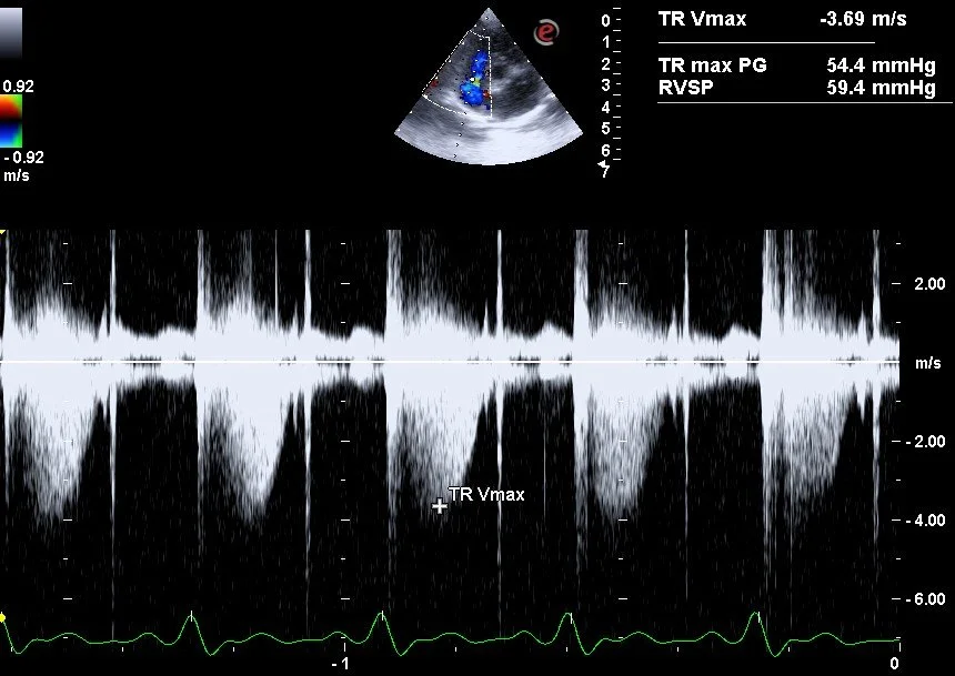 Pulmonary hypertension associated with left-sided heart disease in dogs