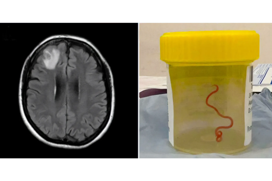 Left side shows a brain MRI scan; right side shows a yellow prescription pill bottle with a red squiggly line drawn on it, placed on a hospital bed or similar surface.