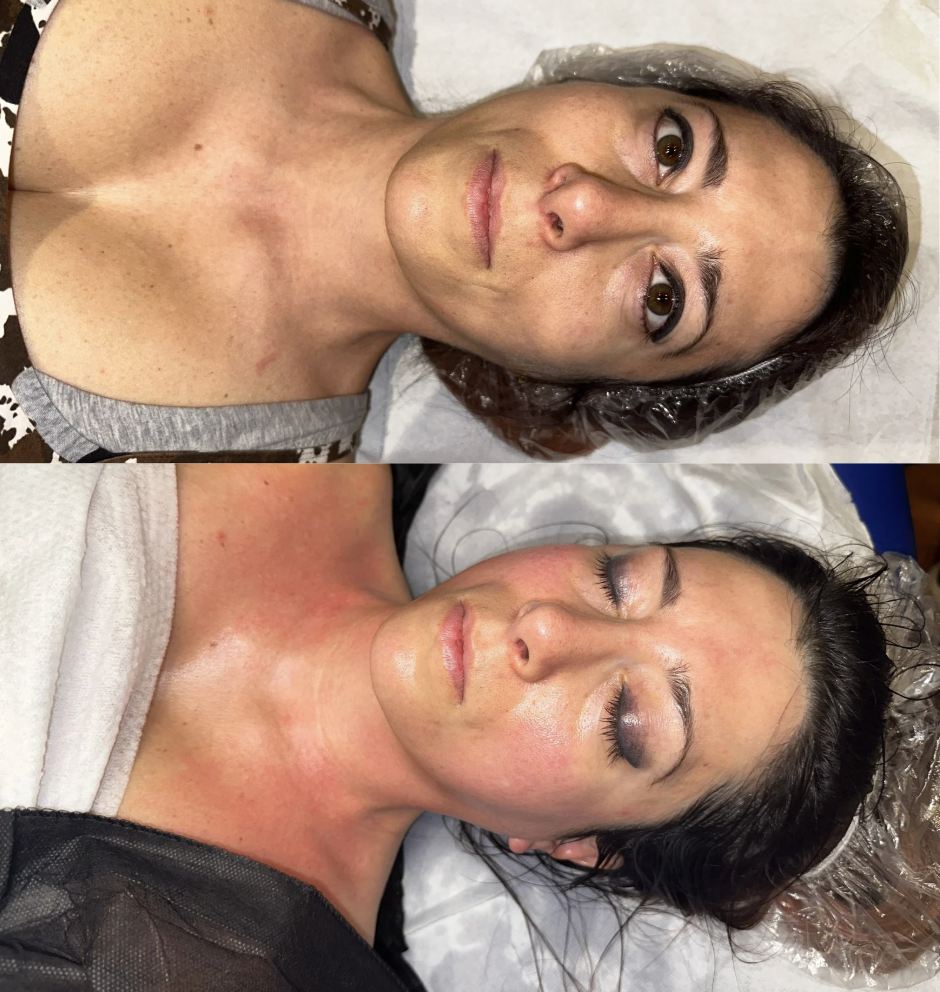 A woman lying down with protective hair cover, before and after a cosmetic facial treatment showing improved skin condition and redness reduction.