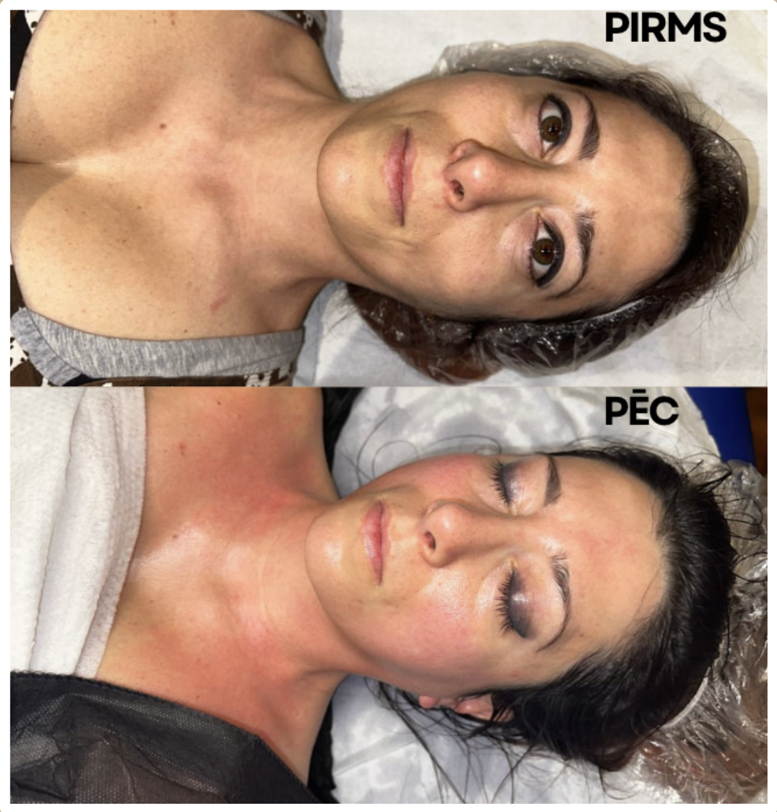 Comparison of a woman's face before and after a cosmetic procedure, showing changes in skin appearance and redness.
