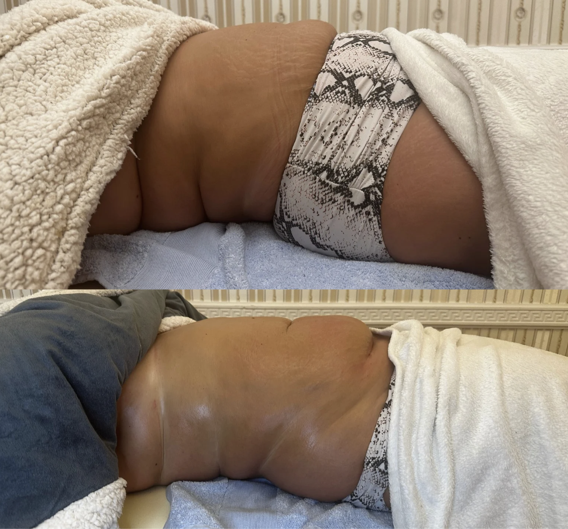 Close-up of a person's side lying on a bed, wearing a towel and having slightly wrinkled, tanned skin.