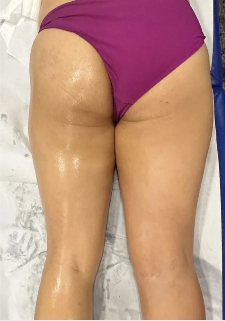 Close-up of a person's lower back, buttocks, and upper thighs, wearing purple shorts, with a tiled floor background.