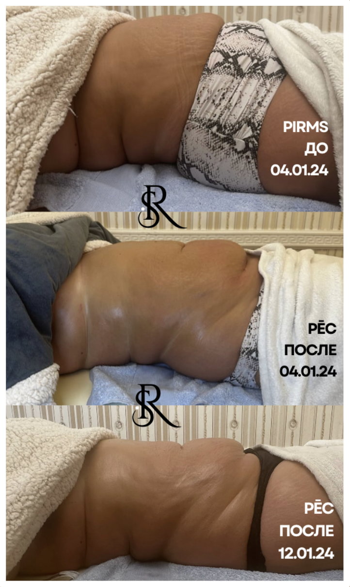 Side view of a person's midsection showing body changes over time, with three photos labeled with dates and captions in Russian. The progression shows skin tightening and reduction of loose skin from January 2024 to April 2024.