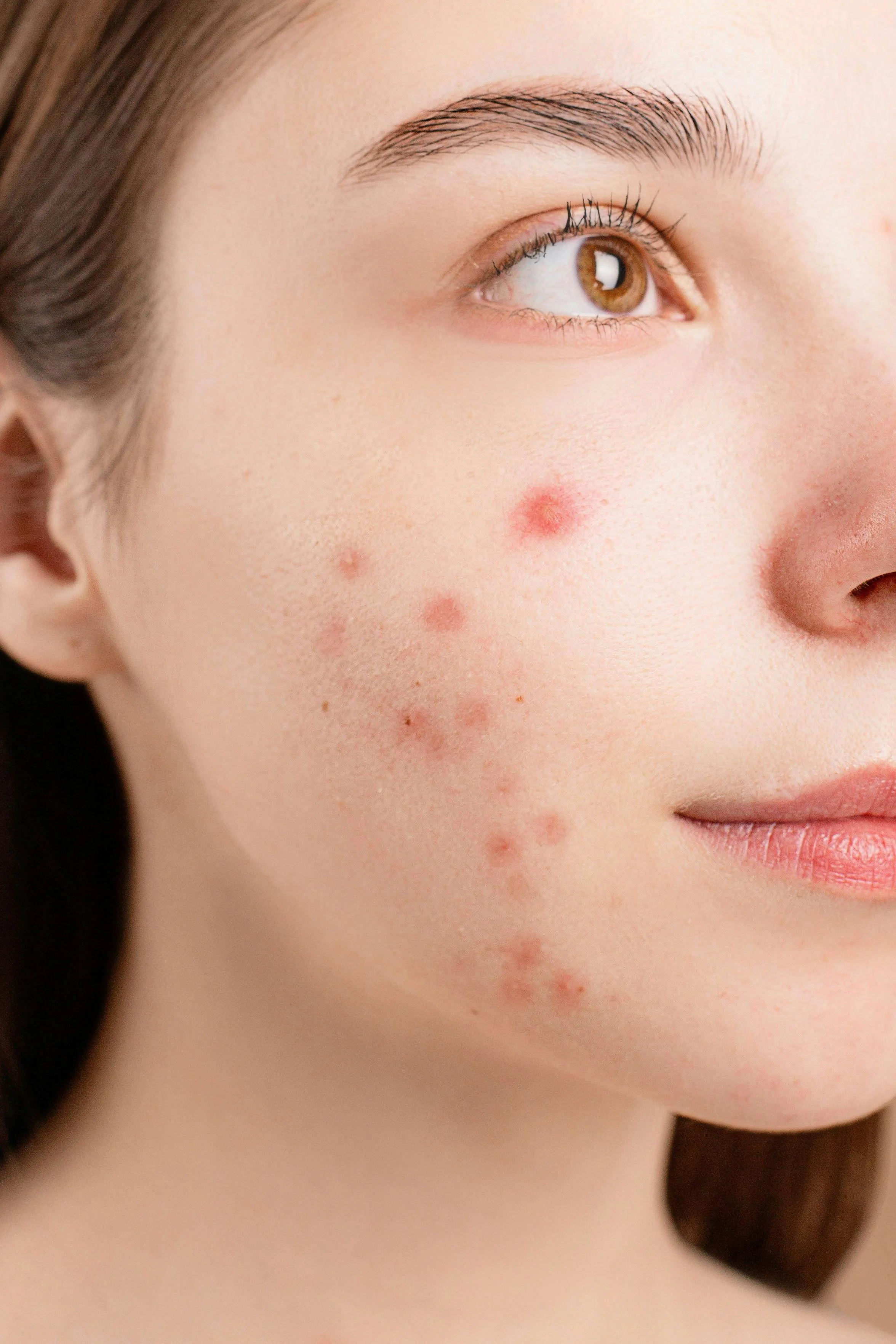 Primer plano de rostro de mujer con acné en mejilla izquierda.