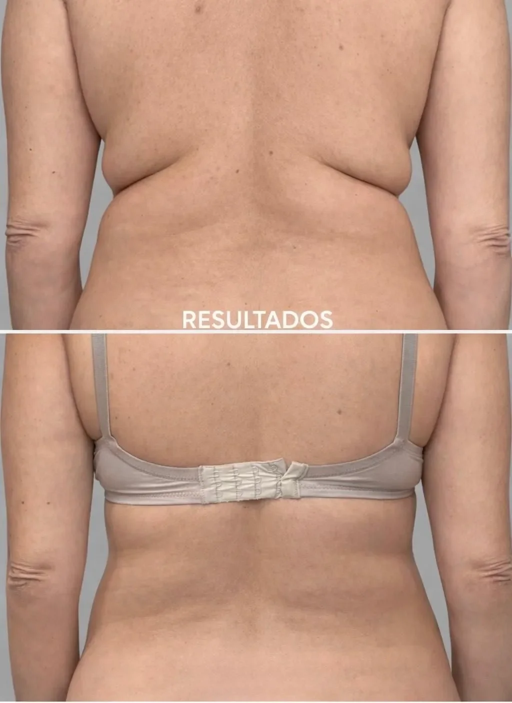 Comparación del resultado de un procedimiento médico en la espalda de una mujer, mostrando antes y después, con la palabra 'RESULTADOS' en la parte inferior.