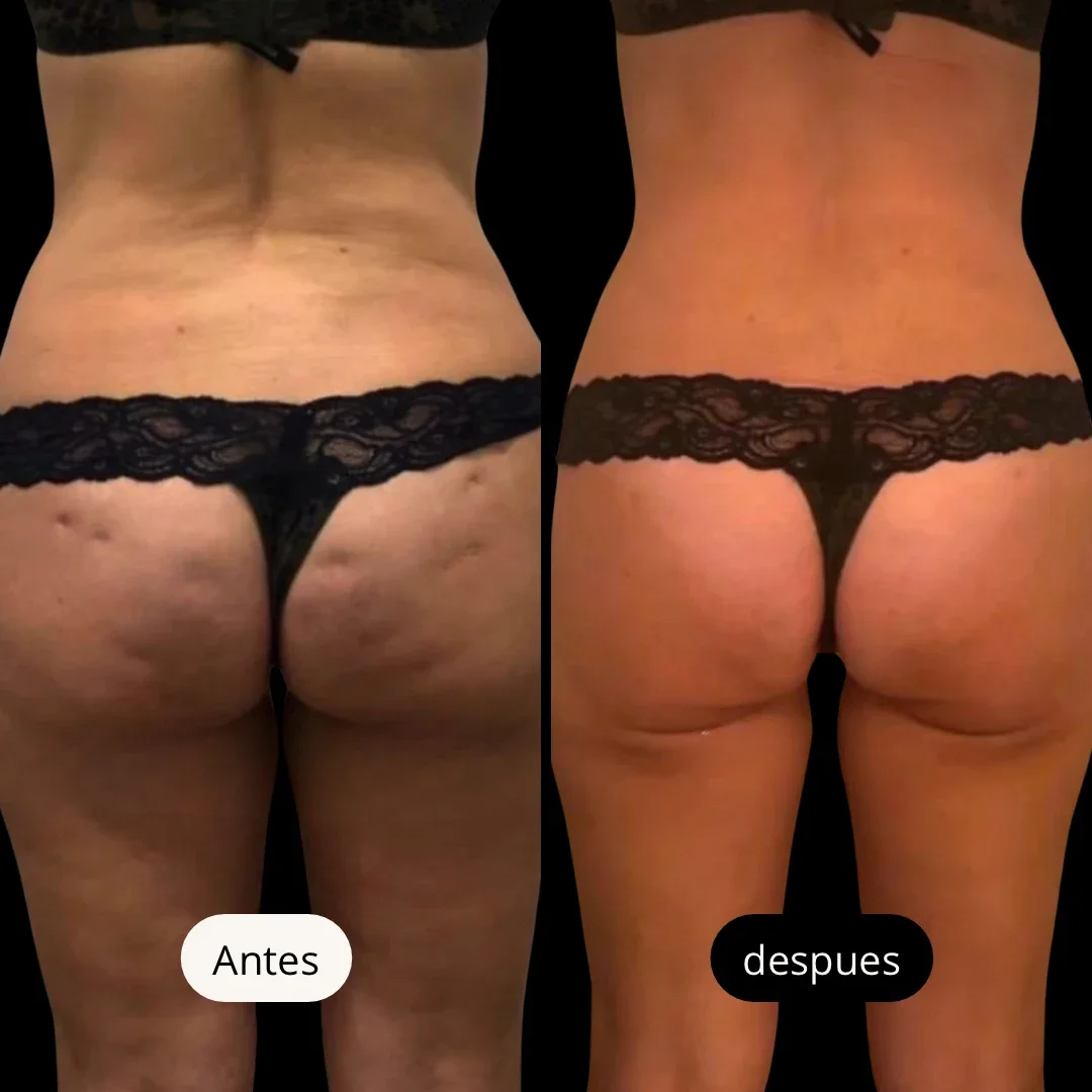 Comparación del trasero de una mujer antes y después de un tratamiento, mostrando mejora en la apariencia de la piel y reducción de celulitis, usando ropa interior negra de encaje y texto en español que dice 'Antes' y 'después'.