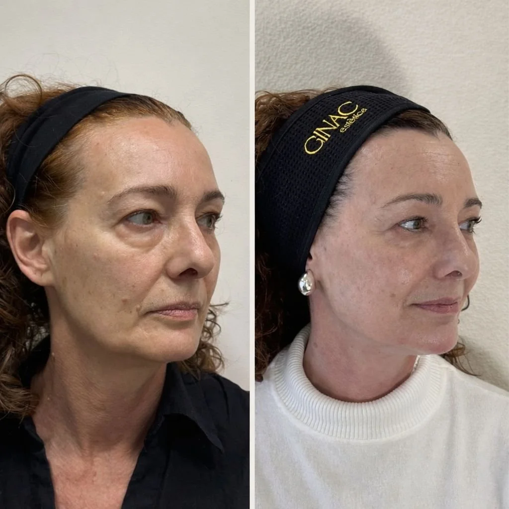 Imagen comparativa de un rostro antes y después de un tratamiento facial, mostrando mejoras en la piel y reducciones en signos de envejecimiento.