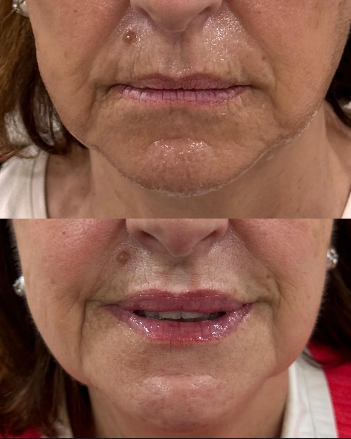 Comparación del área de los labios y la piel de una mujer antes y después de un tratamiento de embellecimiento o cosmético.
